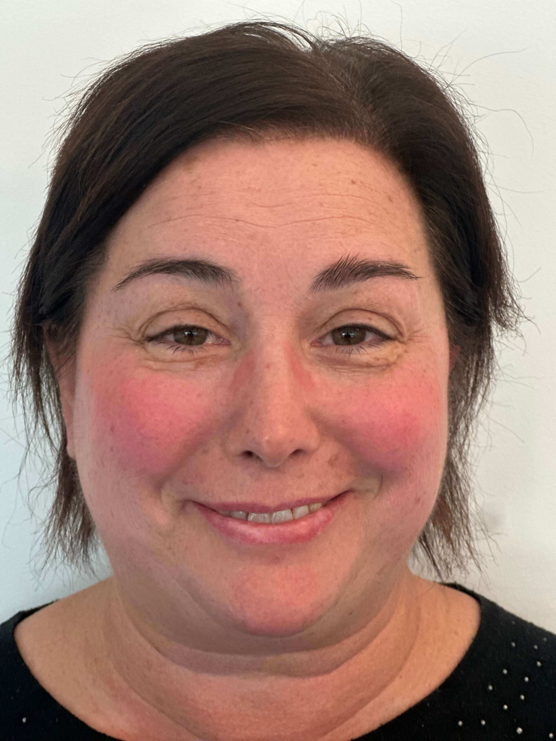 dopo facorefrattiva correzione astigmatismo ipermetropico composto elevato dr angelo appiotti 1 scaled