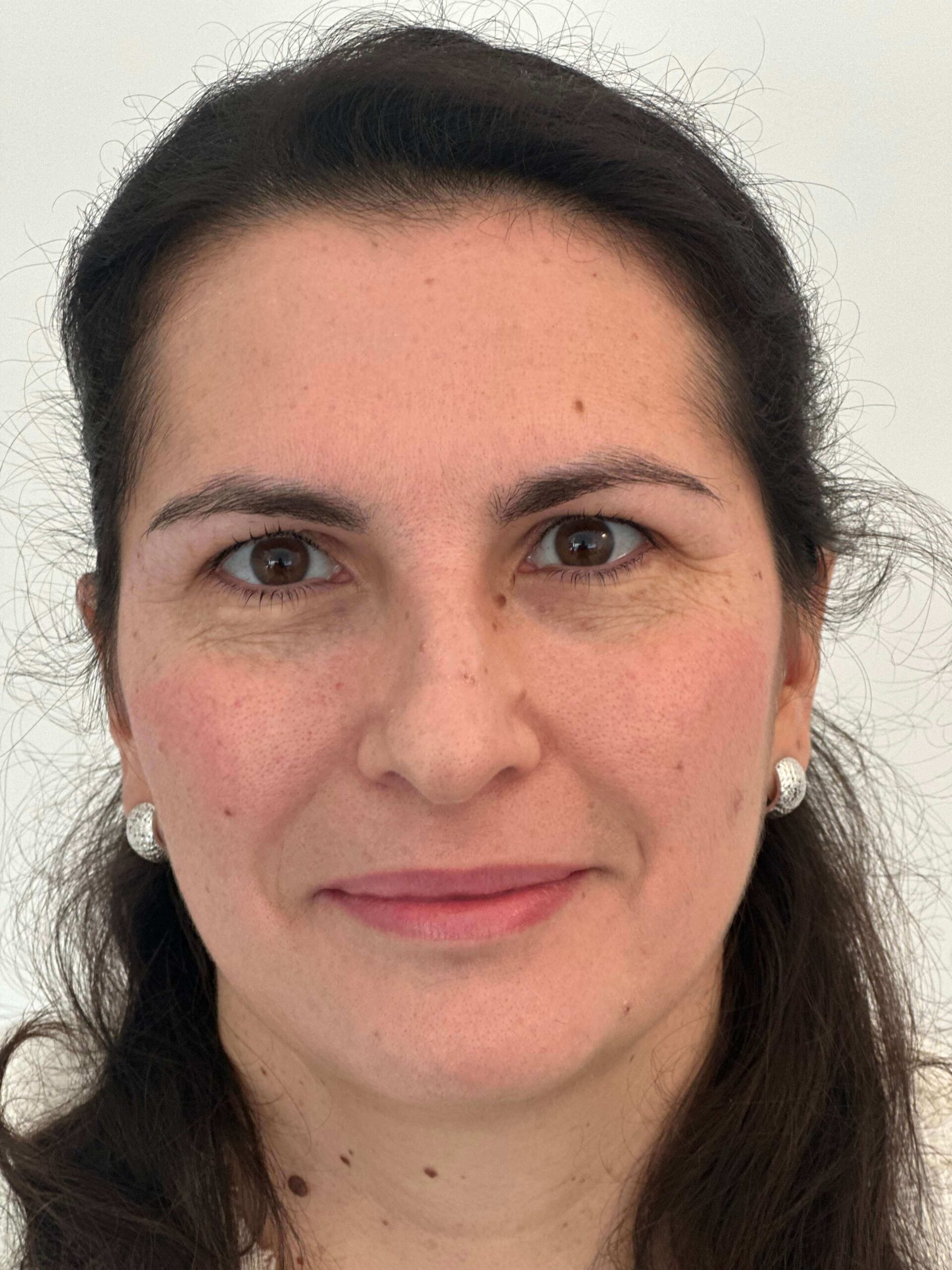 dopo facorefrattiva correzione astigmatismo miopico composto elevato dr angelo appiotti 1 scaled