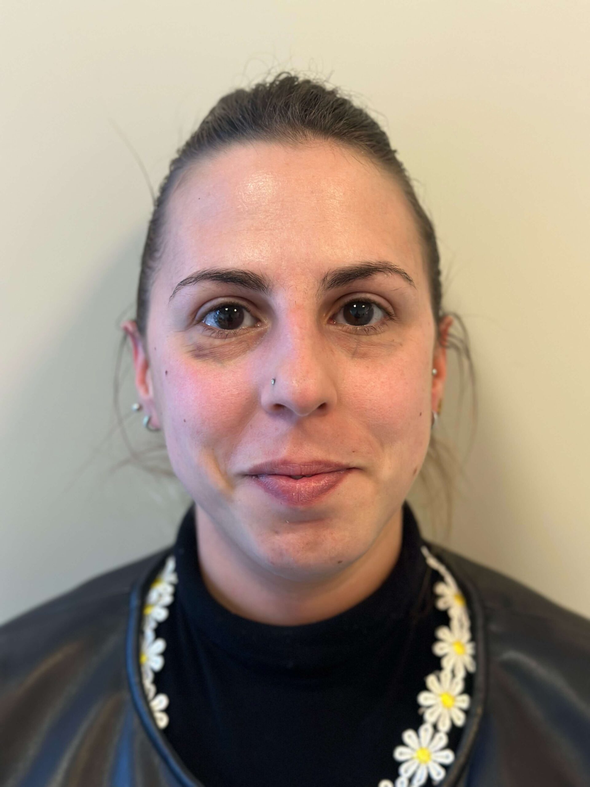 dopo facorefrattiva correzione ipermetropia astigmatismo elevati dr. angelo appiotti 1 scaled