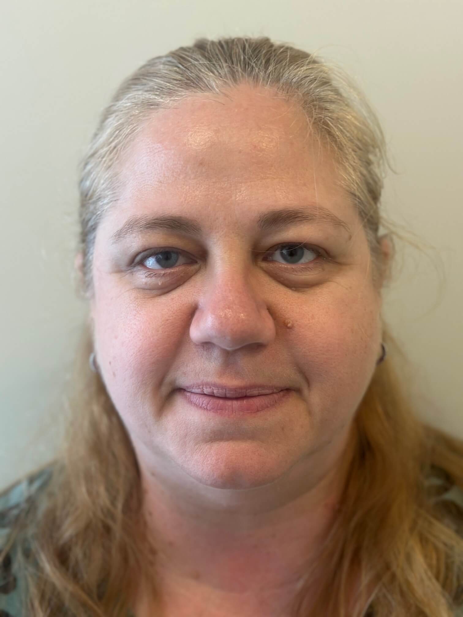 dopo facorefrattiva correzione miopia elevata astigmatismo medio anisometropia dr angelo appiotti