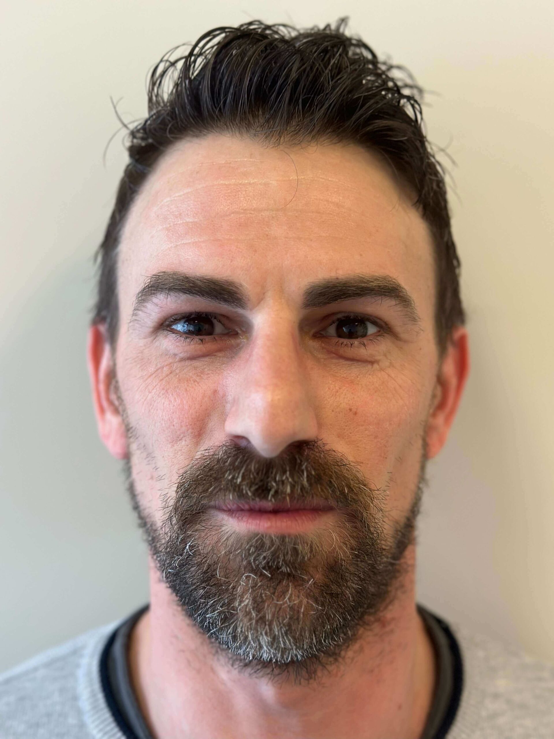 dopo femtolasik correzione astigmatismo elevato miopia media dr. angelo appiotti 1 scaled