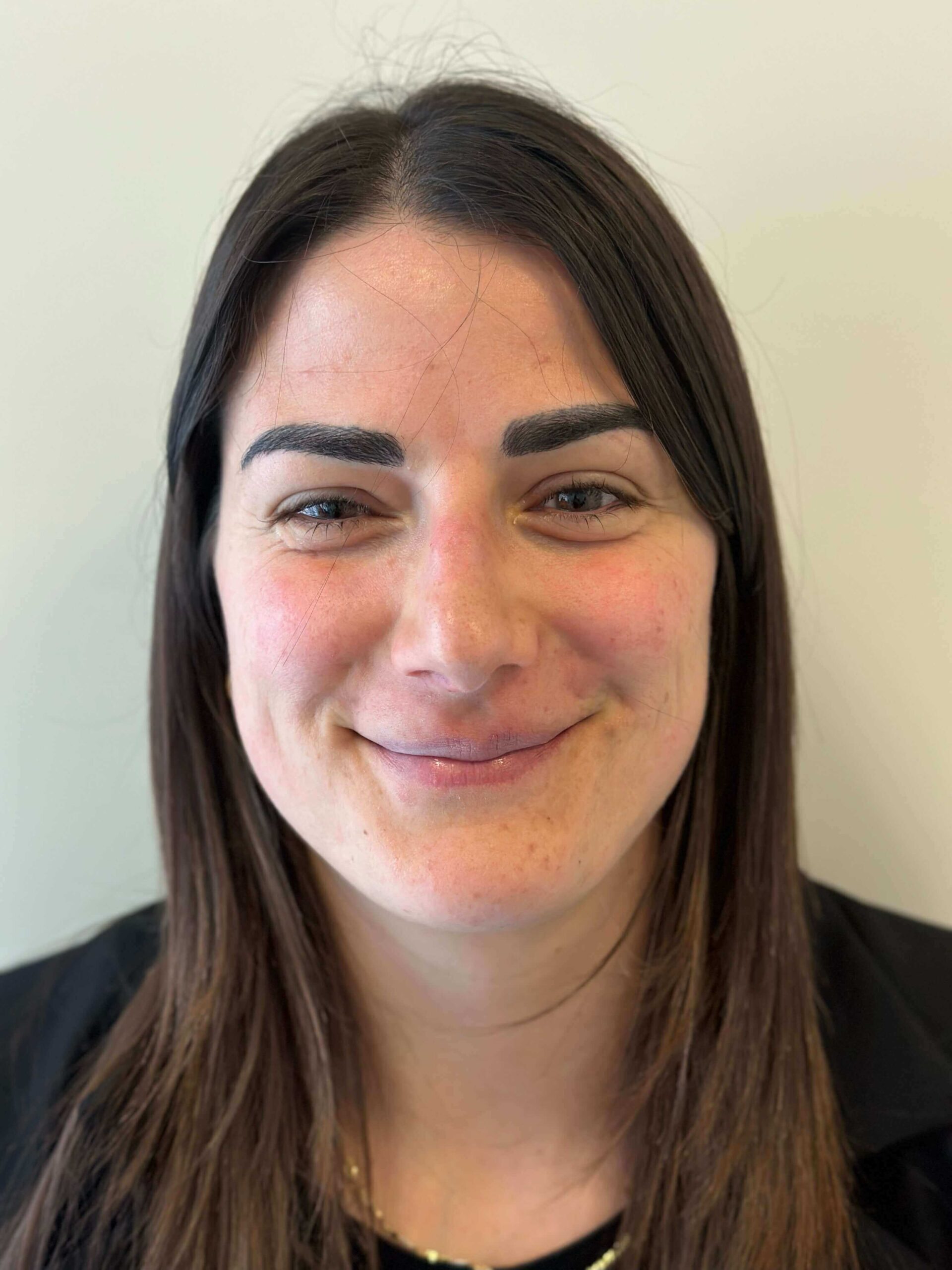 dopo femtolasik correzione ipermetropia elevata astigmatismo lieve dr. angelo appiotti scaled