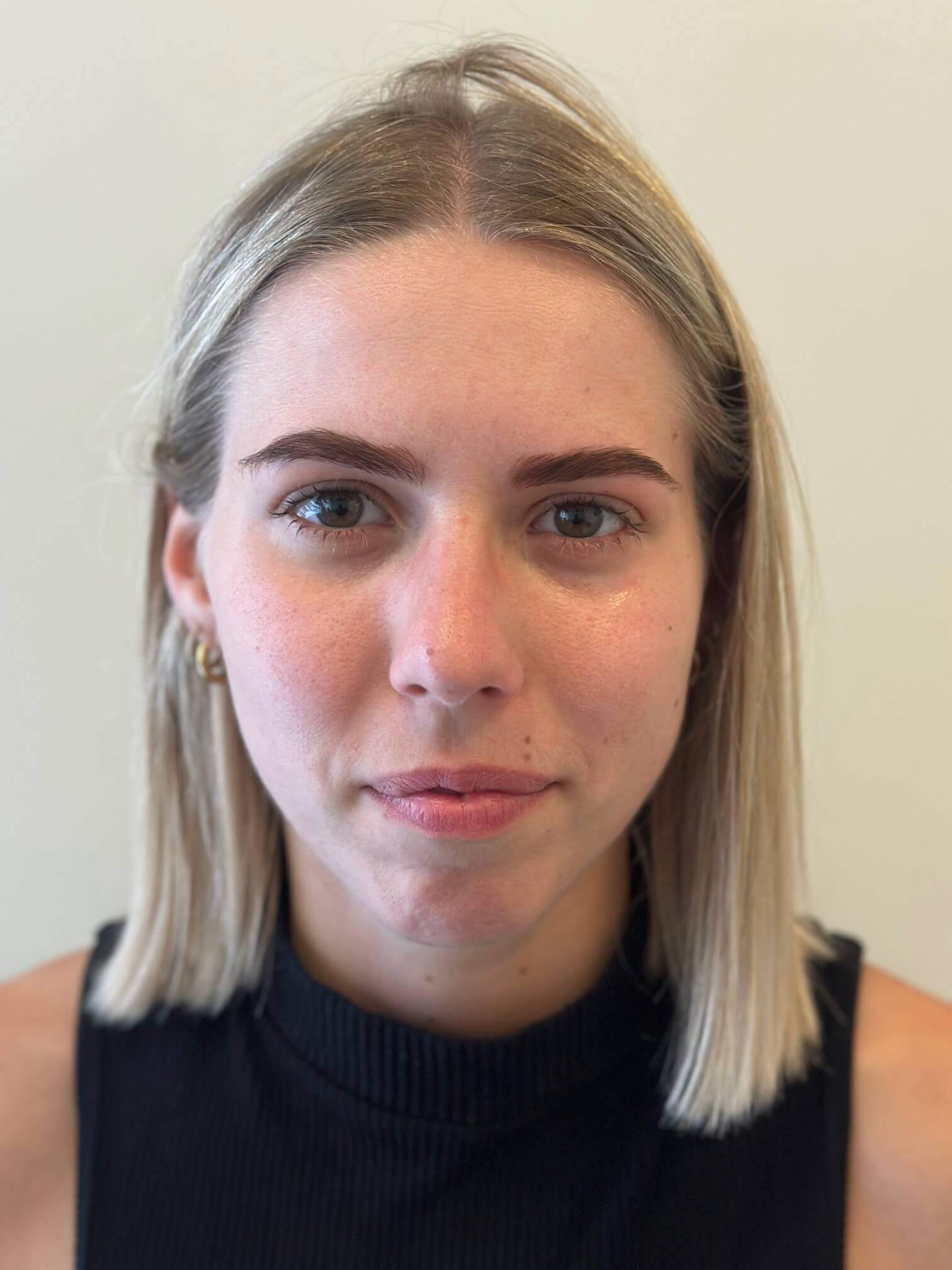 dopo femtolasik correzione ipermetropia media astigmatismo elevato dr. angelo appiotti