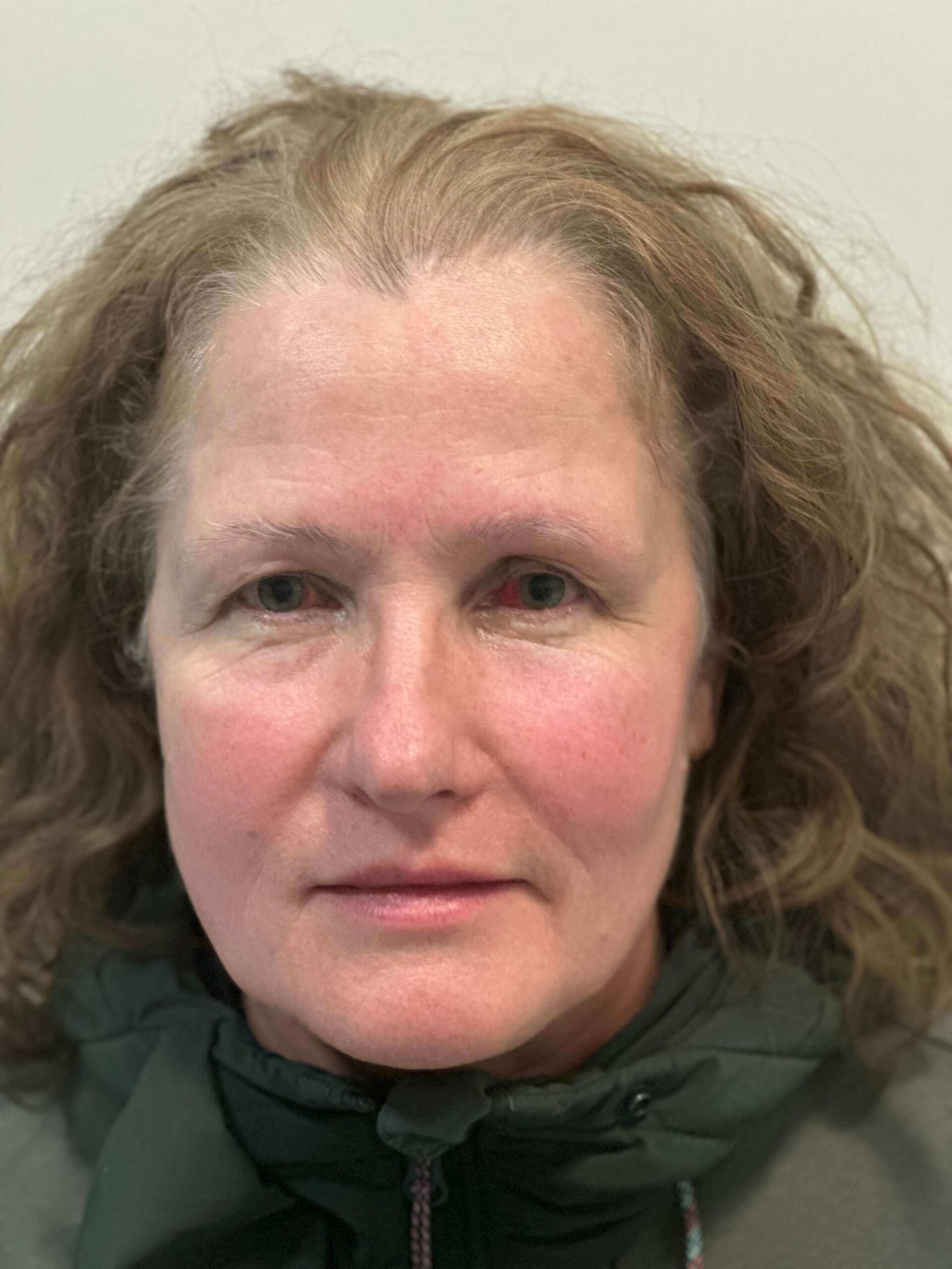 dopo femtolasik correzione ipermetropia media presbiopia elevata dr. angelo appiotti 1 scaled