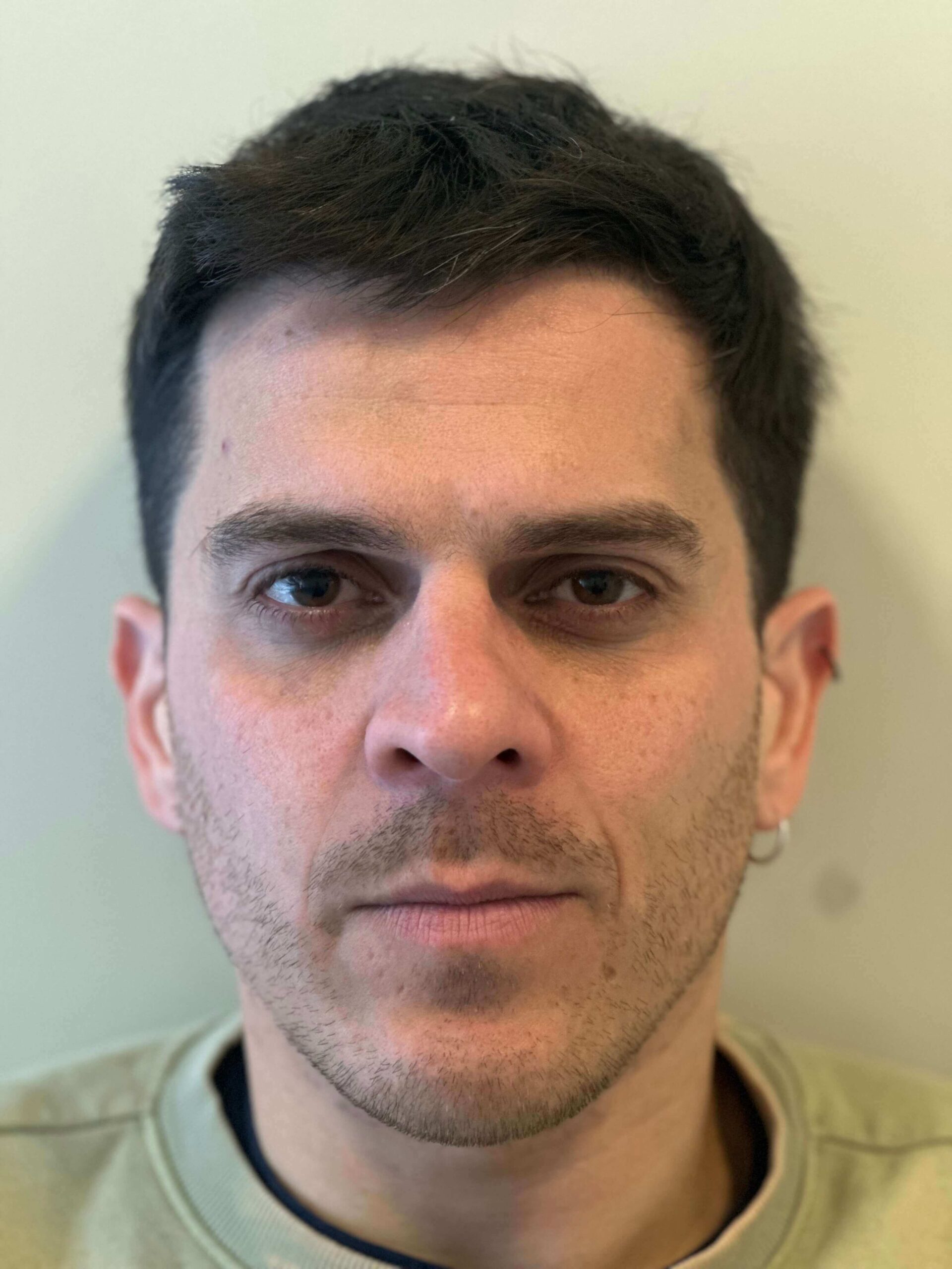 dopo femtolasik correzione miopia astigmatismo lievi dr. angelo appiotti scaled