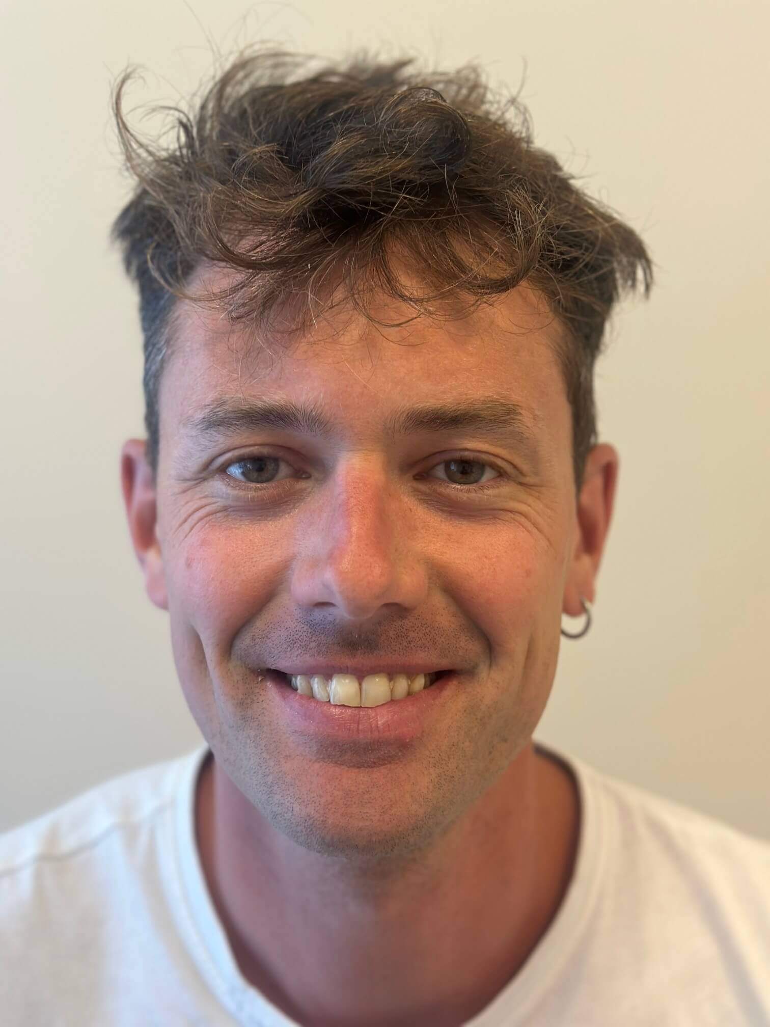 dopo femtolasik correzione miopia astigmatismo medi dr. angelo appiotti