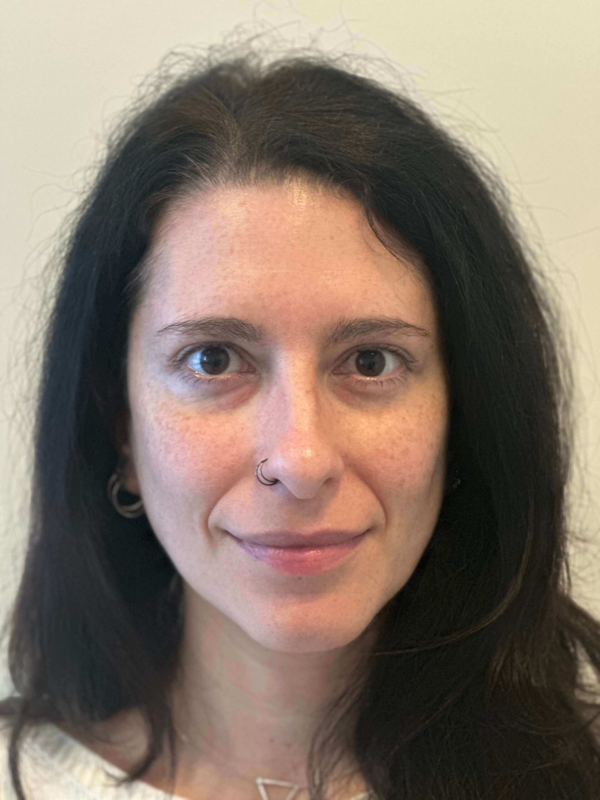 dopo femtolasik correzione miopia lieve dr. angelo appiotti scaled