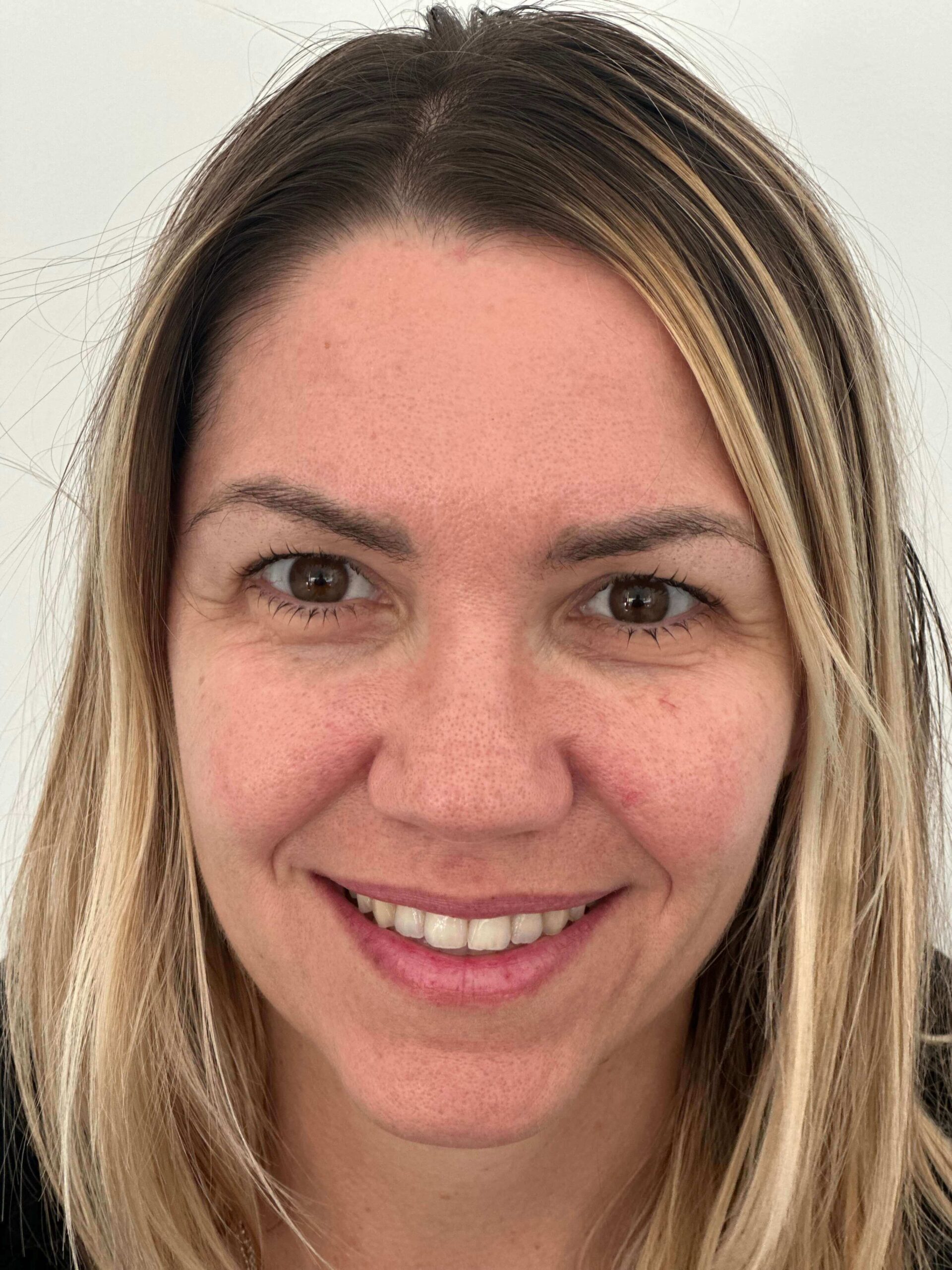 dopo femtolasik correzione miopia media astigmatismo lieve dr. angelo appiotti 1 scaled