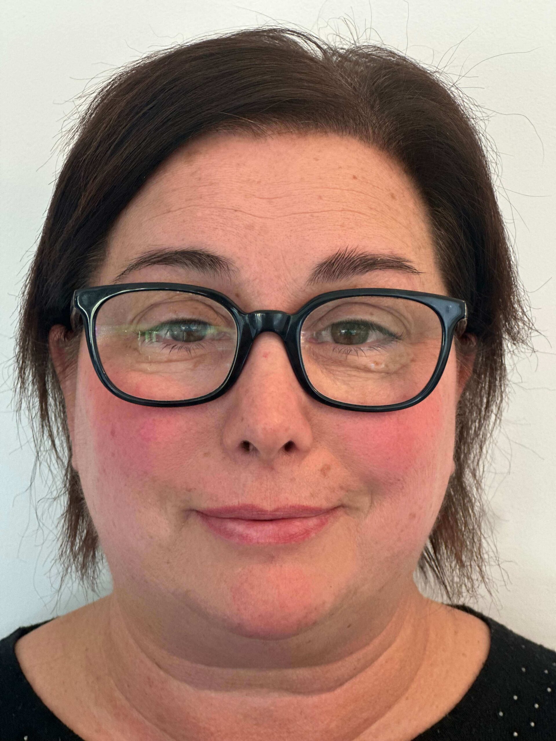 prima facorefrattiva correzione astigmatismo ipermetropico composto elevato dr angelo appiotti 1 scaled