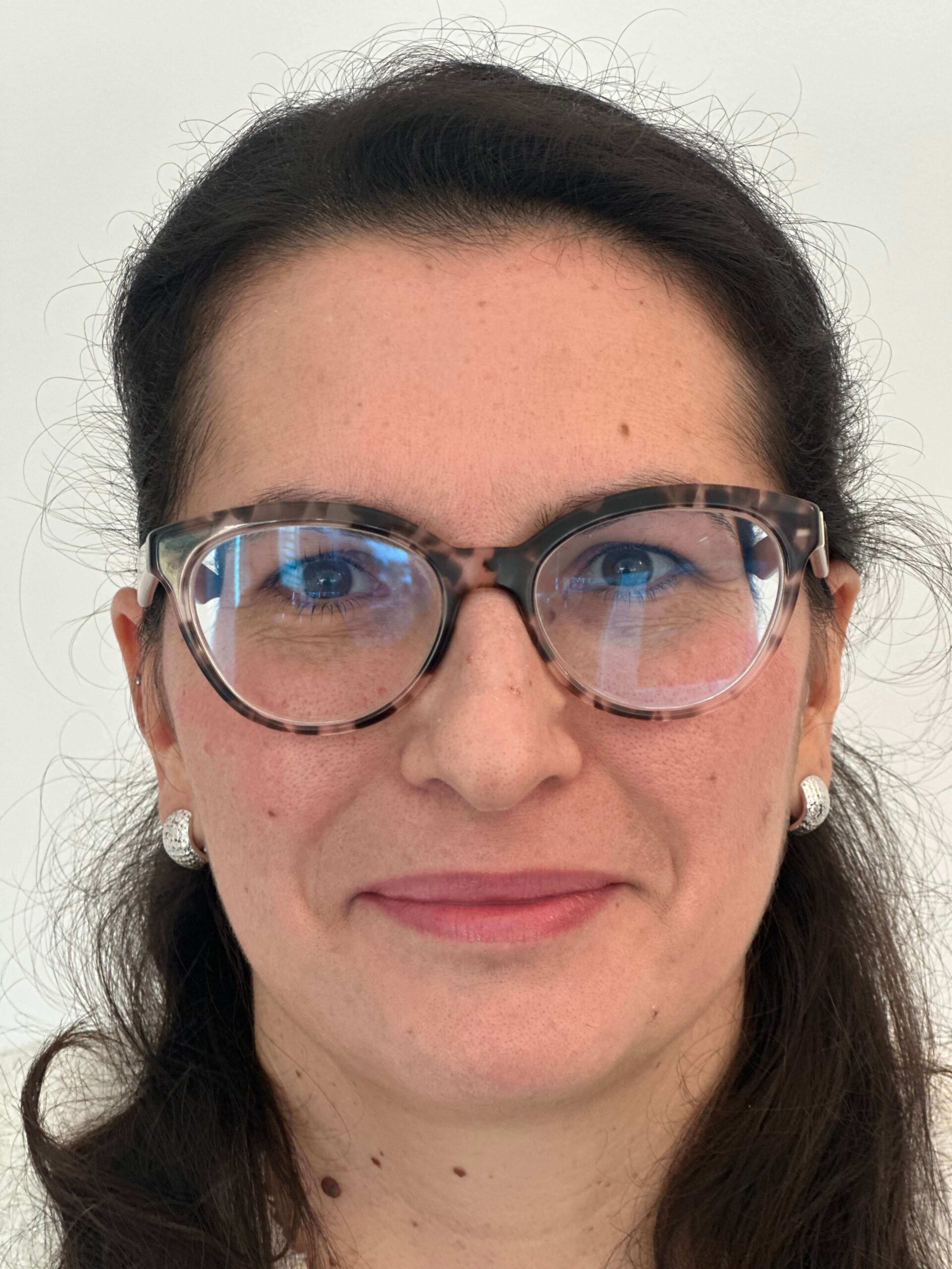 prima facorefrattiva correzione astigmatismo miopico composto elevato dr angelo appiotti 1 scaled