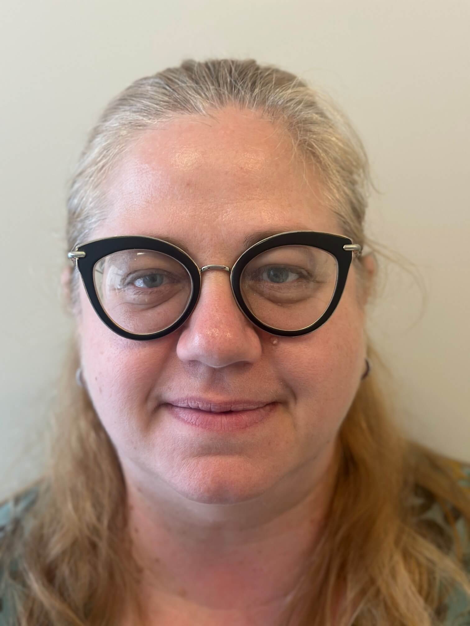 prima facorefrattiva correzione miopia elevata astigmatismo medio anisometropia dr angelo appiotti