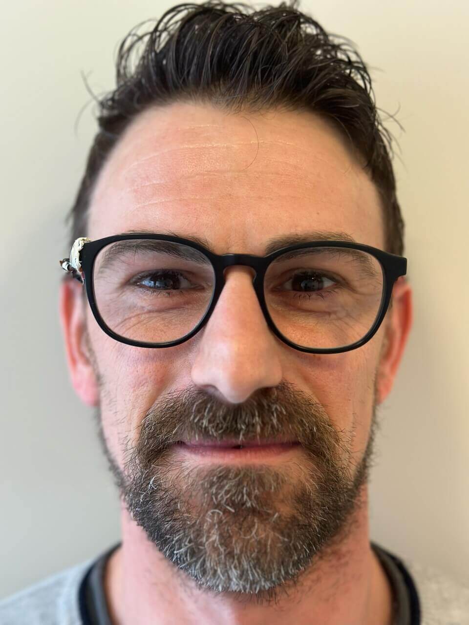 prima femtolasik correzione astigmatismo elevato miopia media dr. angelo appiotti