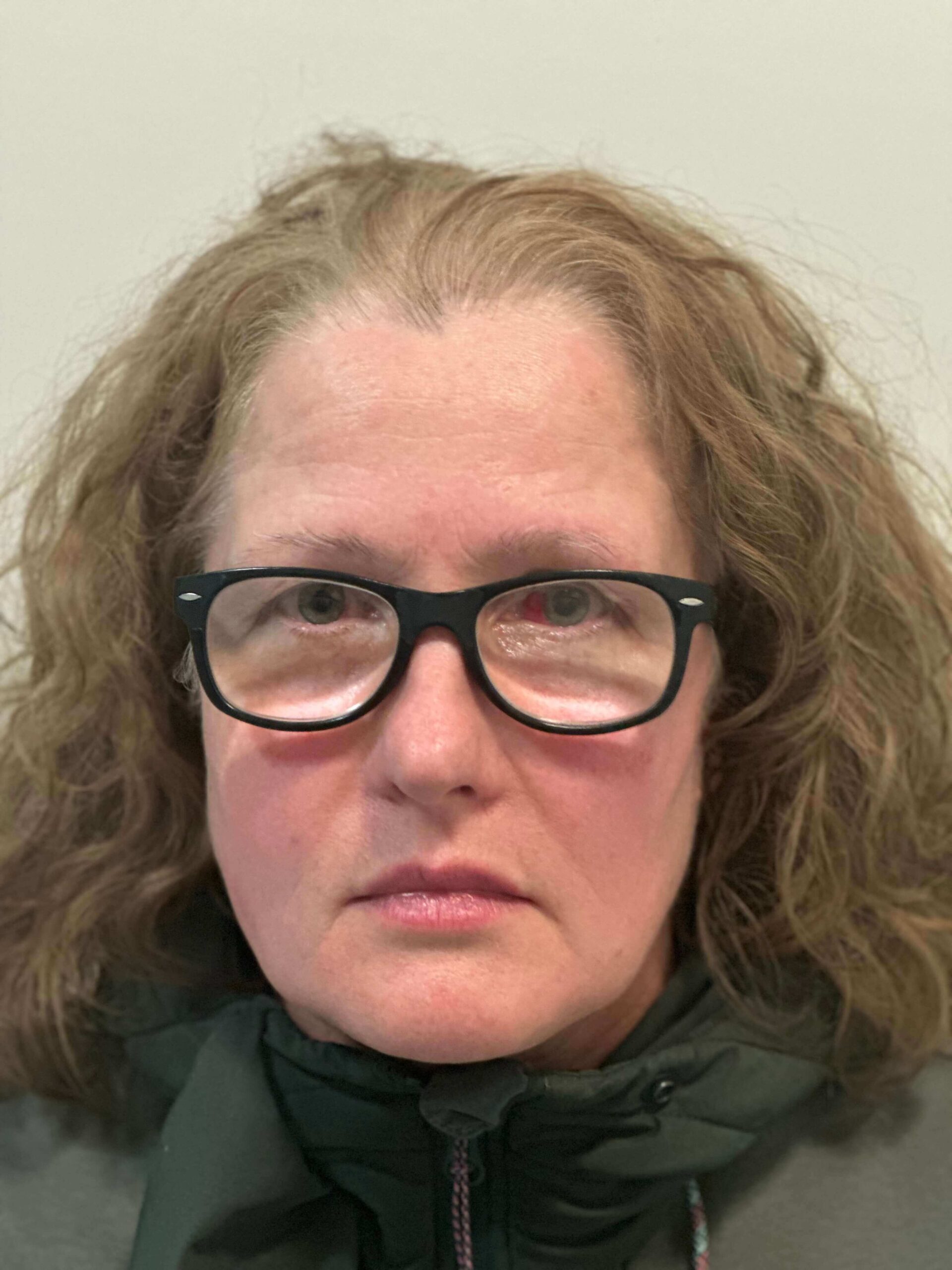 prima femtolasik correzione ipermetropia media presbiopia elevata dr. angelo appiotti scaled