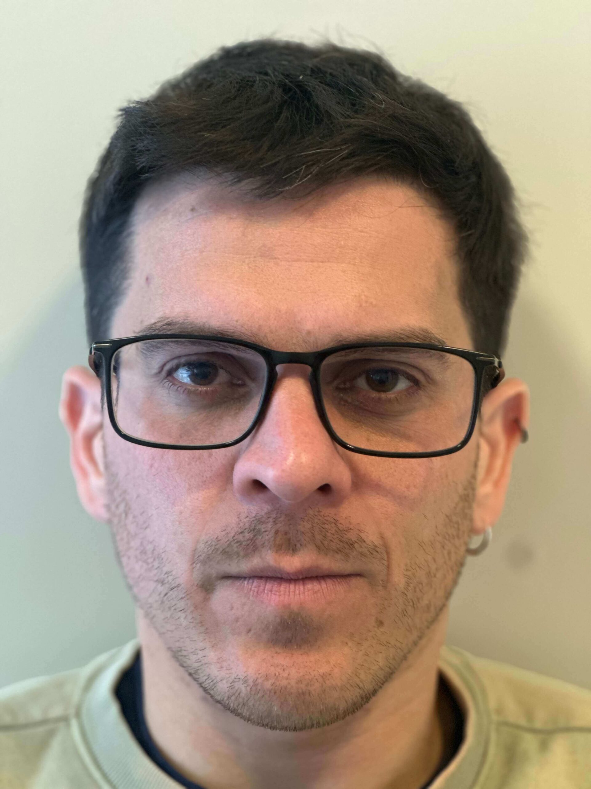 prima femtolasik correzione miopia astigmatismo lievi dr. angelo appiotti scaled