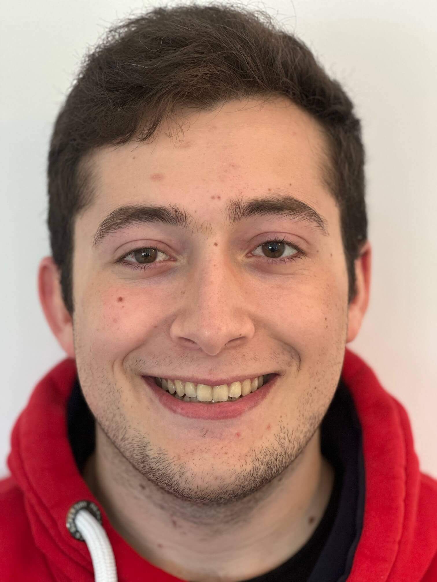 dopo icl correzione astigmatismo miopico composto elevato dr. angelo appiotti