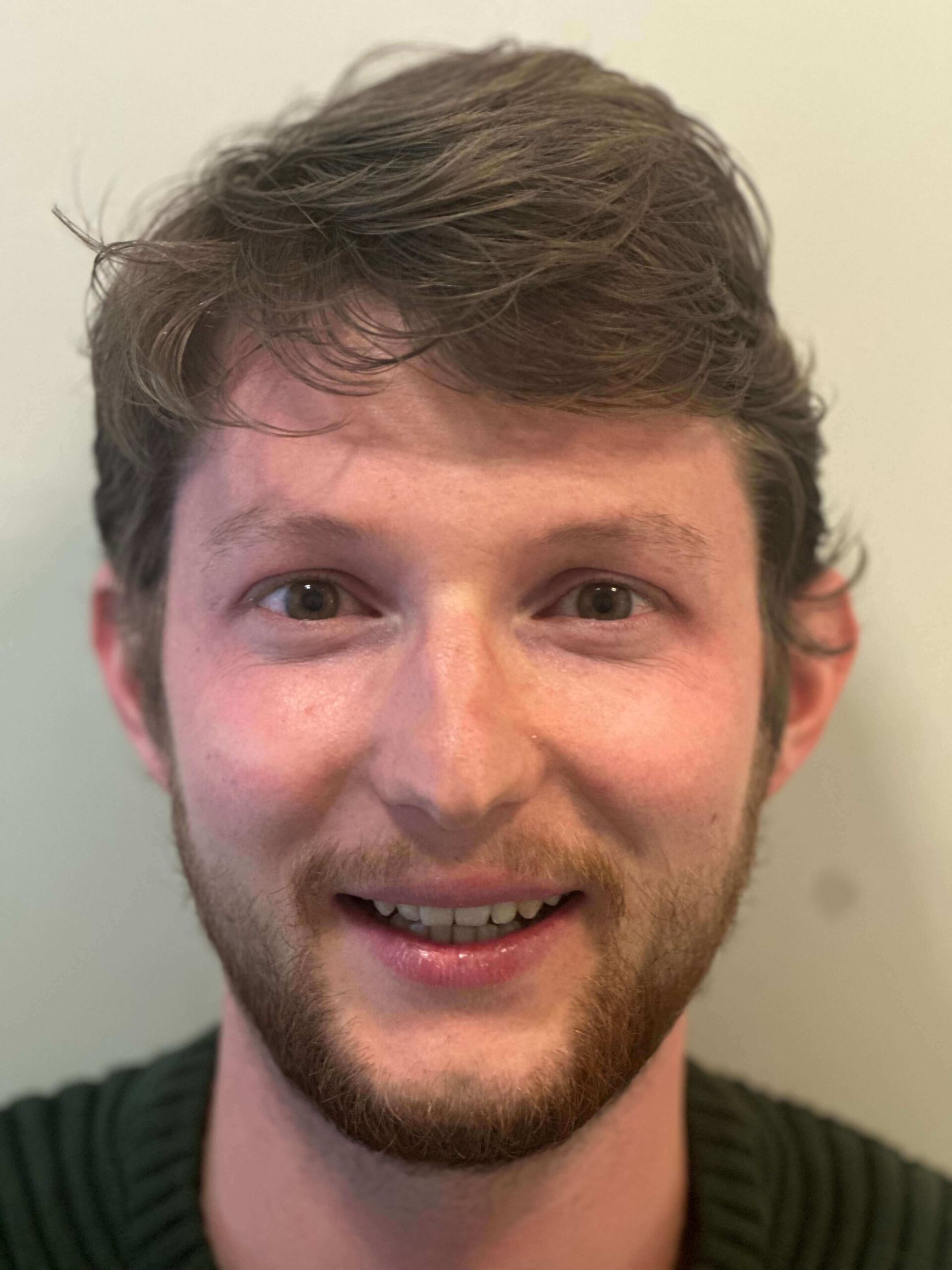 dopo icl correzione miopia elevata astigmatismo lieve dr. angelo appiotti scaled