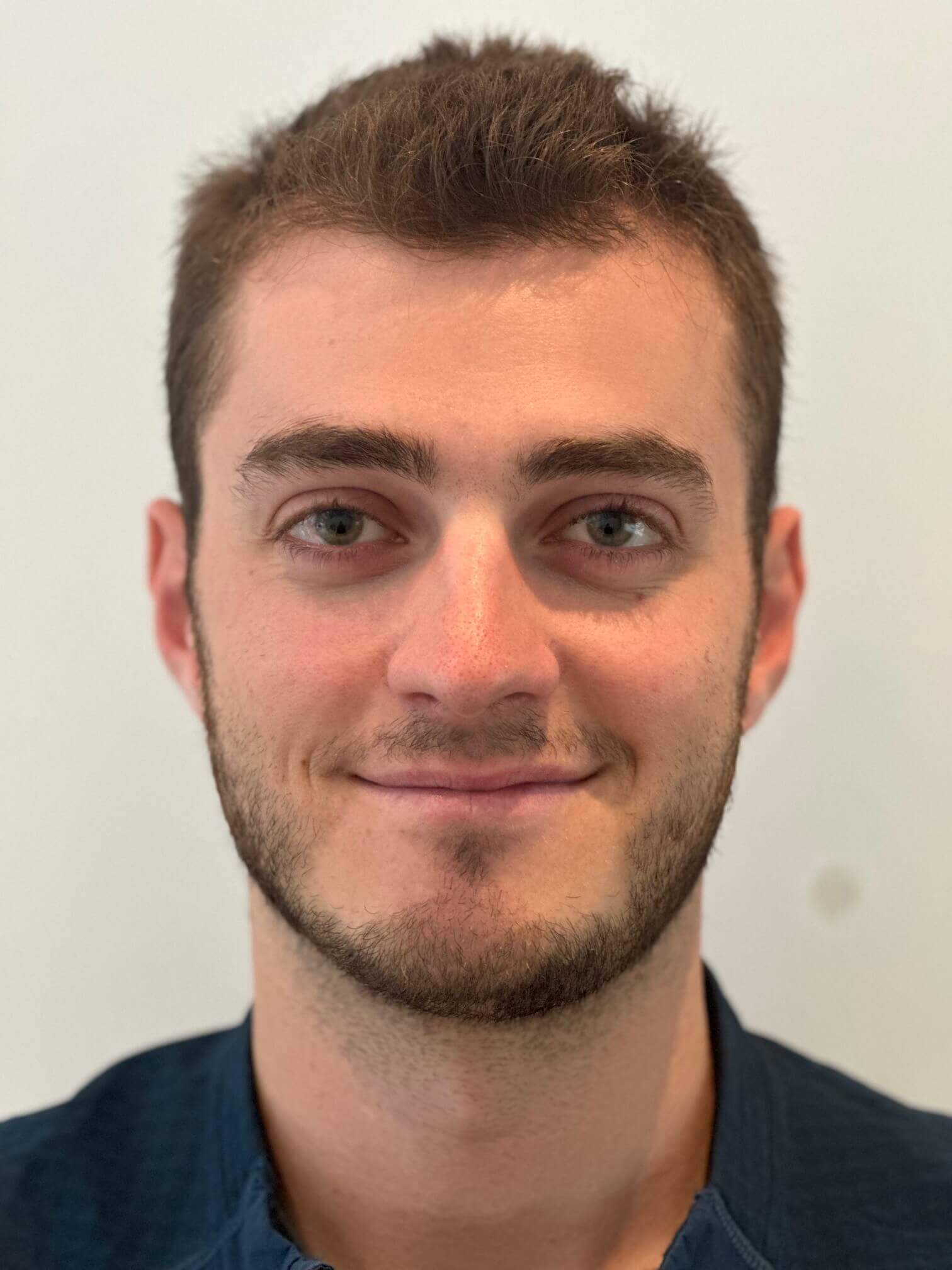 dopo icl correzione miopia elevata astigmatismo lieve medio dr. angelo appiotti