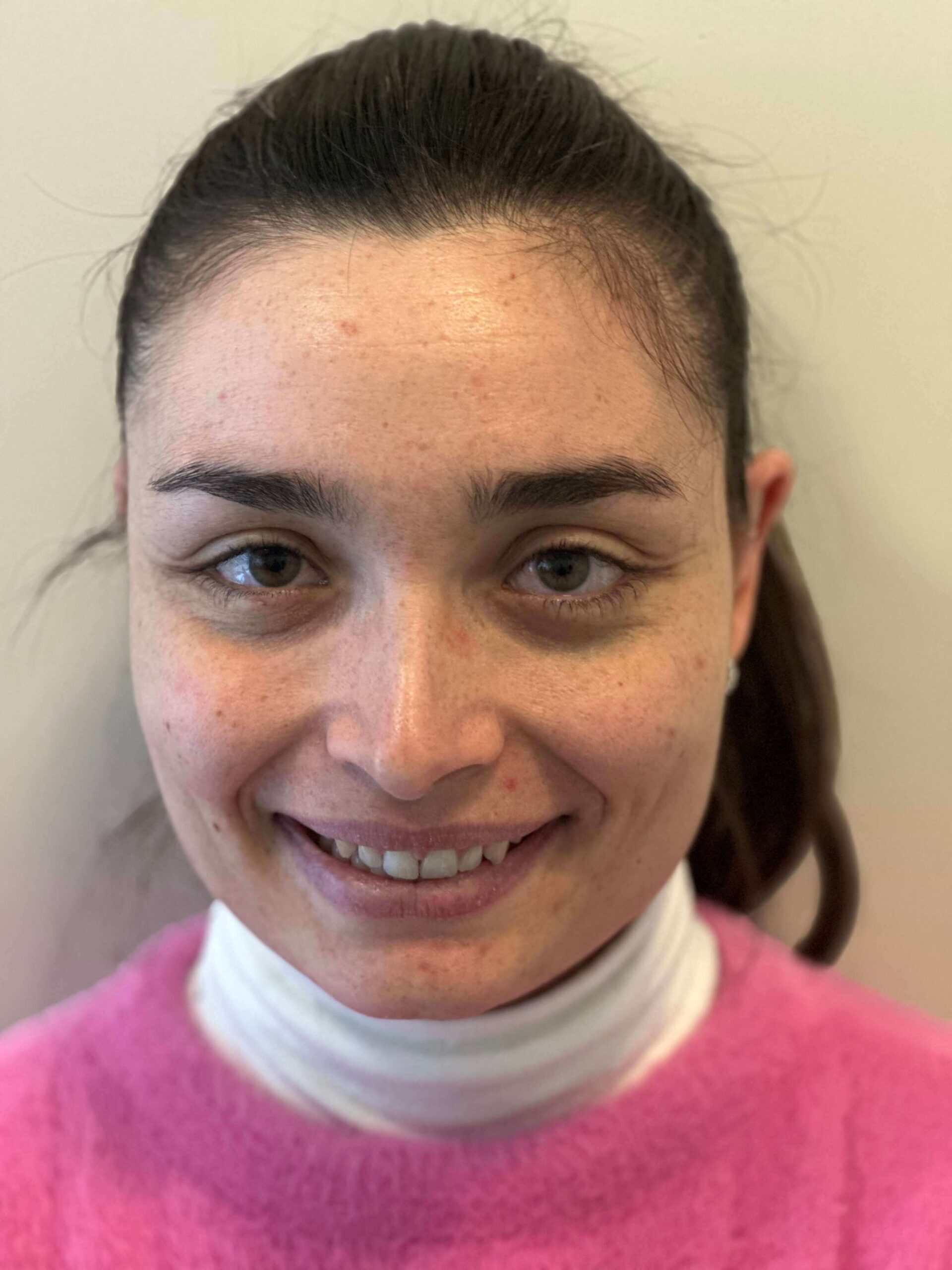 dopo icl correzione miopia elevata astigmatismo medio dr. angelo appiotti scaled