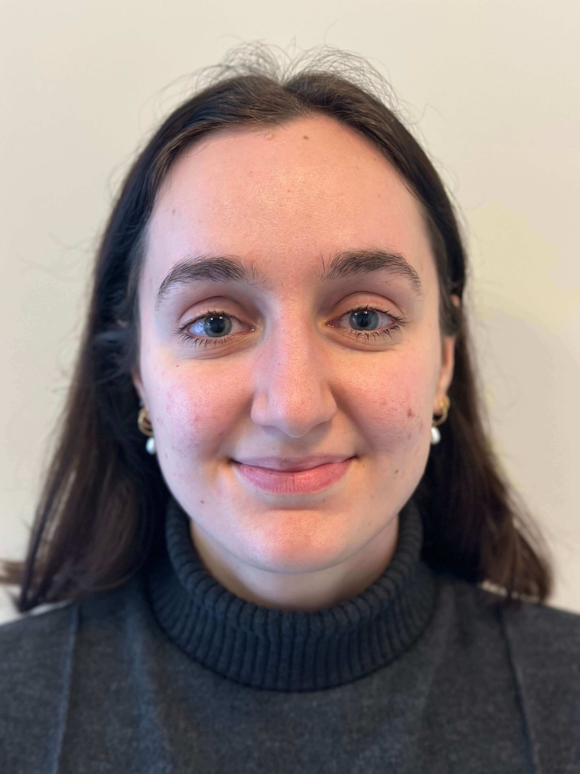 dopo icl correzione miopia elevata dr. angelo appiotti scaled