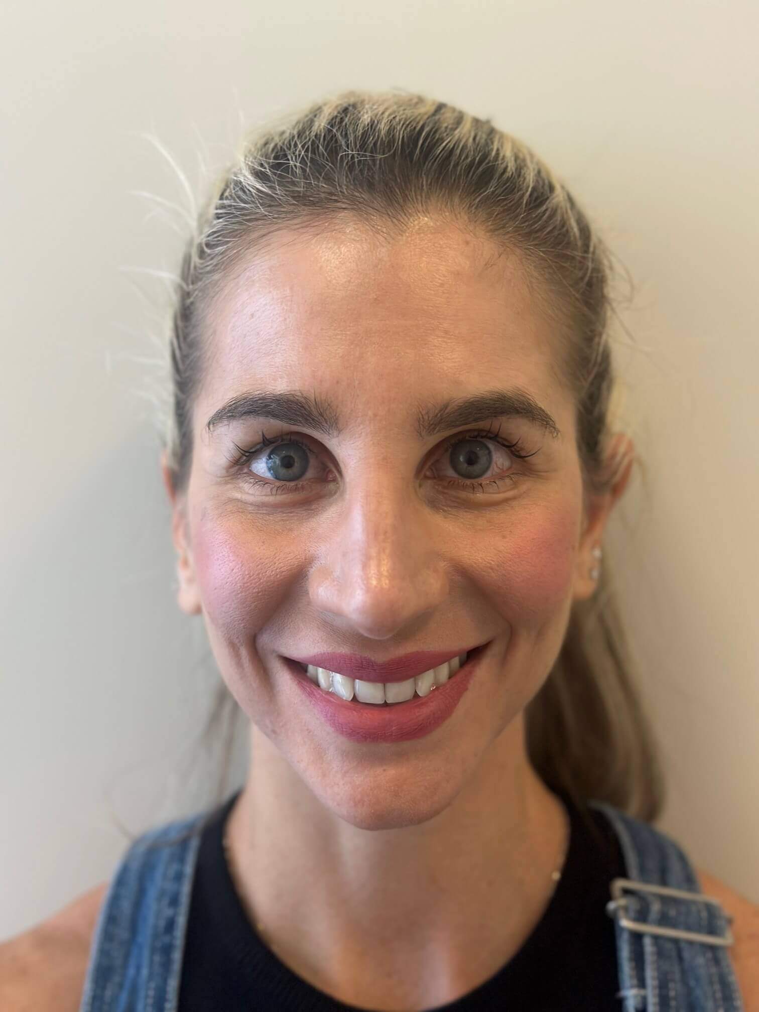 dopo icl correzione miopia media astigmatismo lieve dr. angelo appiotti