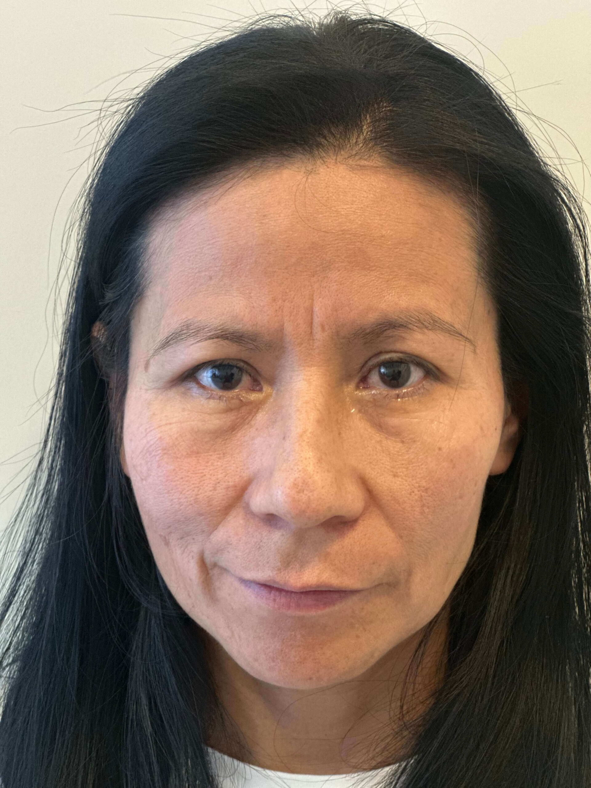 dopo prk correzione miopia astigmatismo medi dr. angelo appiotti scaled