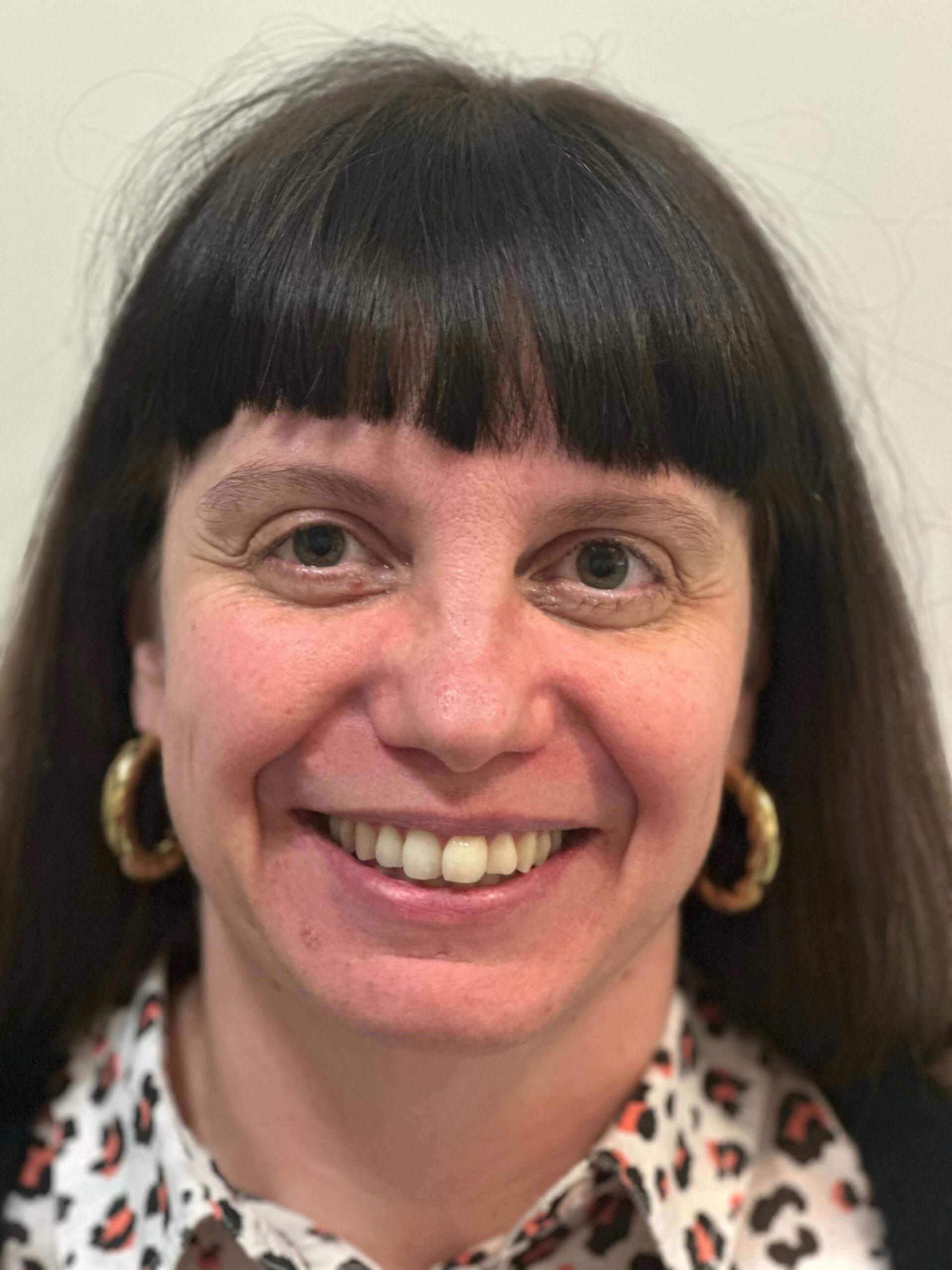 dopo prk correzione miopia media elevata astigmatismo medio dr. angelo appiotti scaled