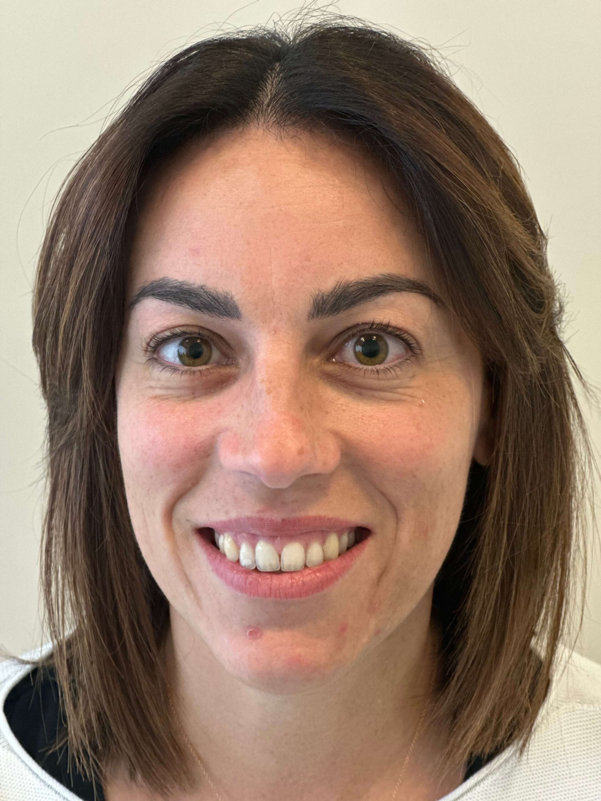 dopo prk xtra correzione miopia media elevata astigmatismo medio dr. angelo appiotti scaled