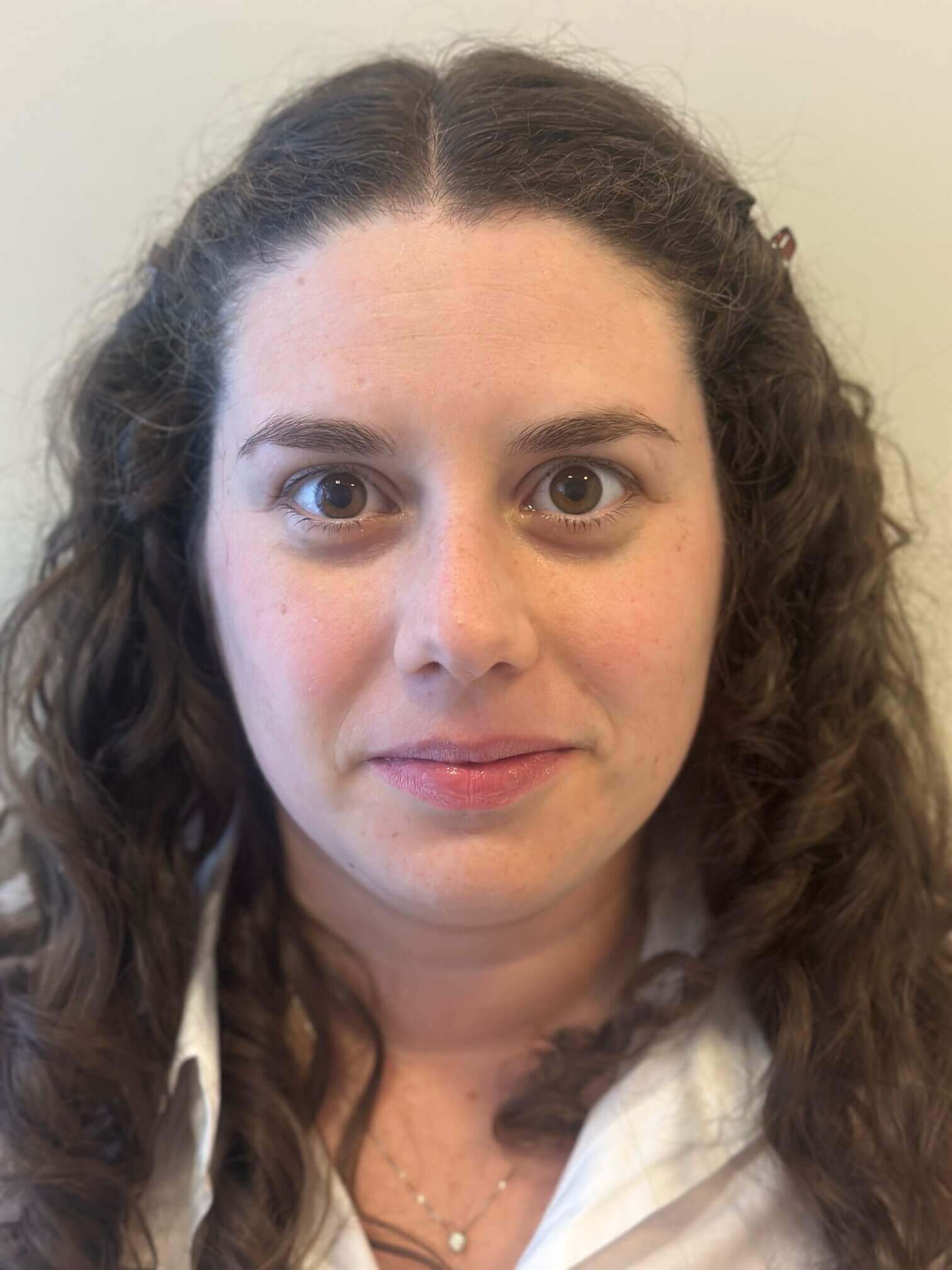 dopo relex smile correzione miopia astigmatismo medi dr. angelo appiotti