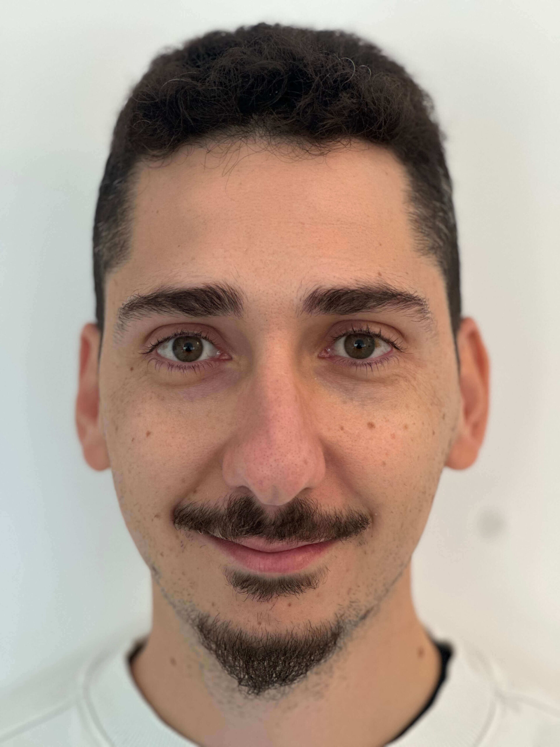 dopo relex smile correzione miopia elevata dr. angelo appiotti 1 scaled