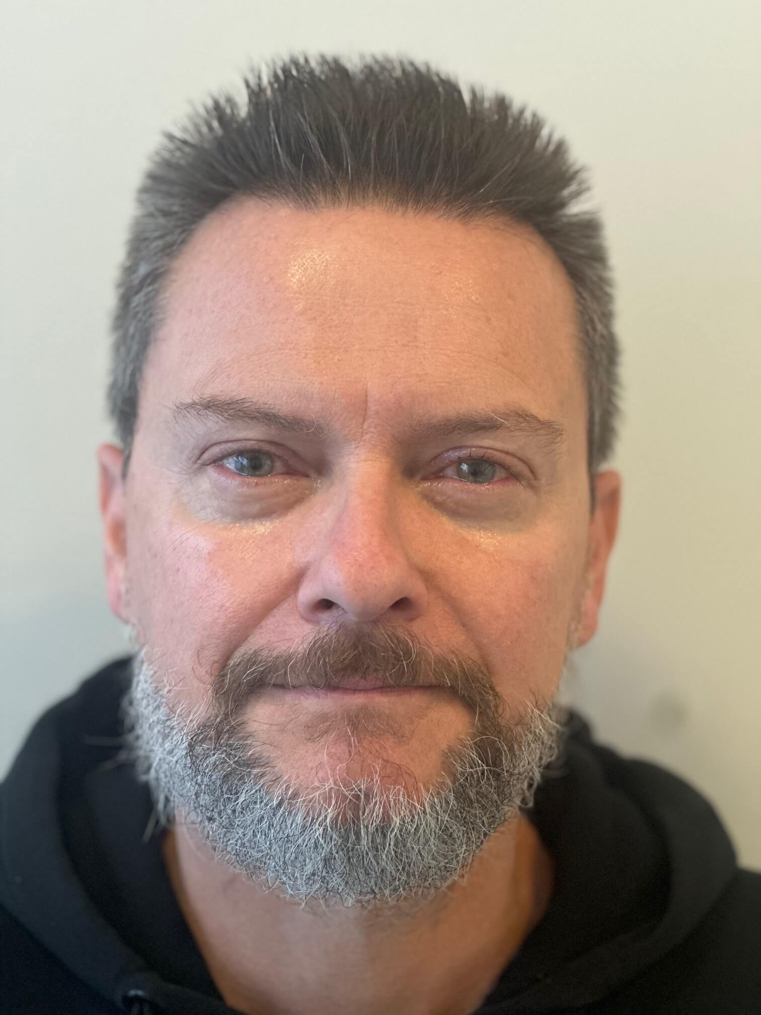 dopo relex smile correzione miopia elevata dr. angelo appiotti 2