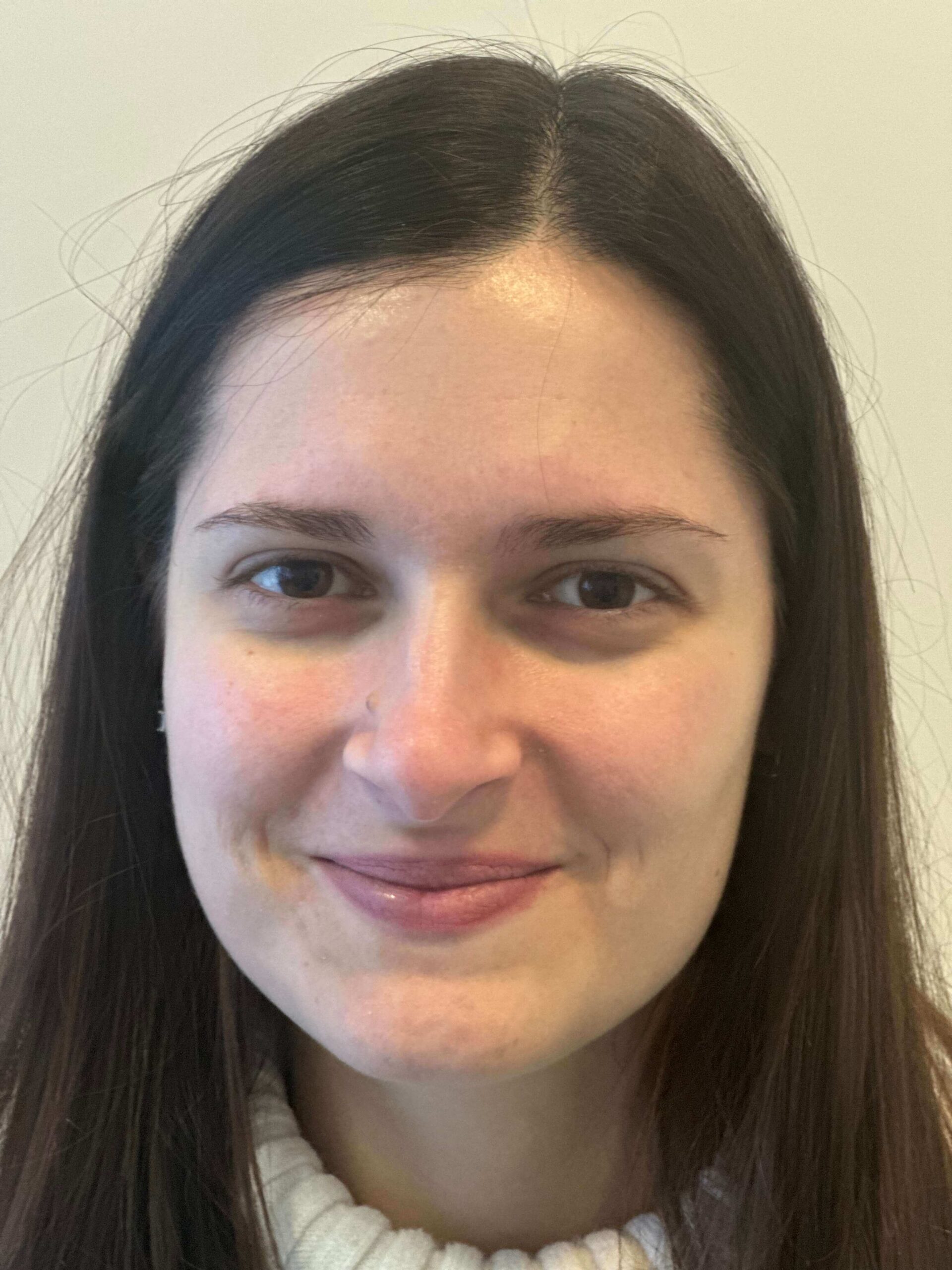 dopo relex smile correzione miopia elevata dr. angelo appiotti scaled