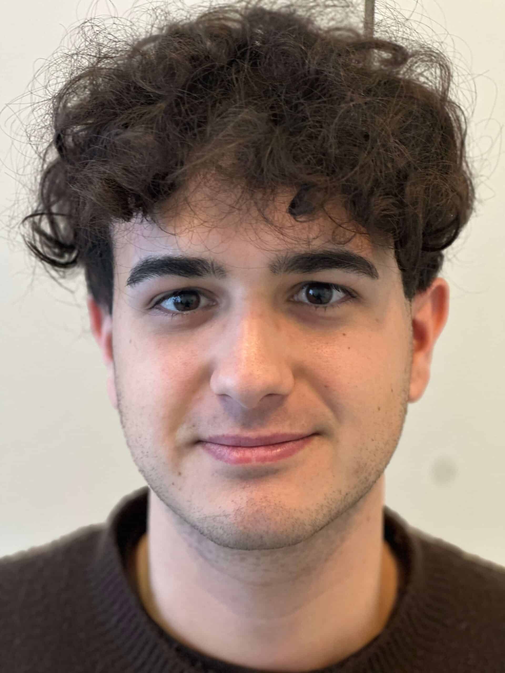 dopo relex smile xtra correzione miopia media astigmatismo lieve dr. angelo appiotti scaled