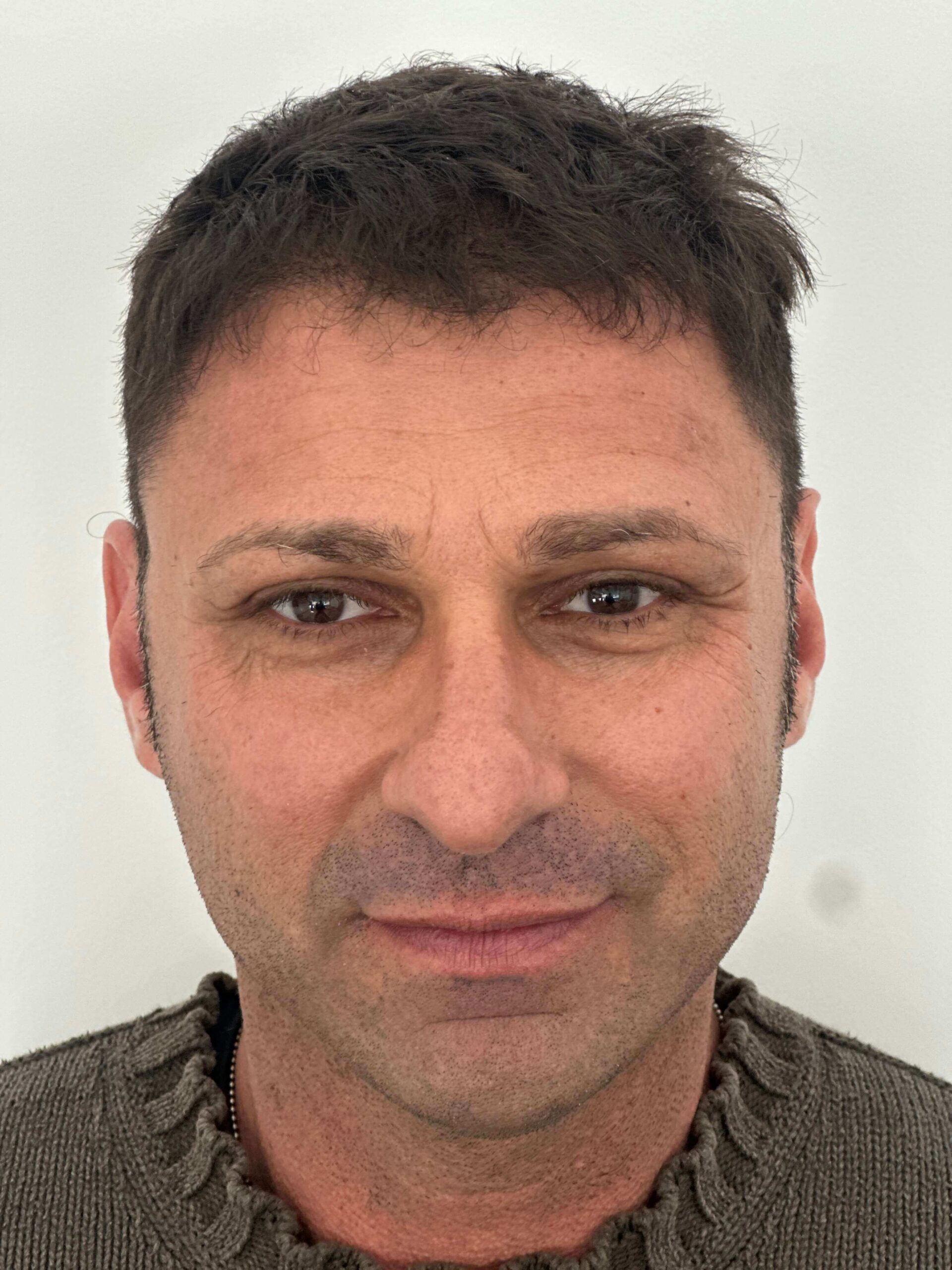 dopo supracor femtolasik correzione astigmatismo ipermetropico composto elevato dr. angelo appiotti scaled