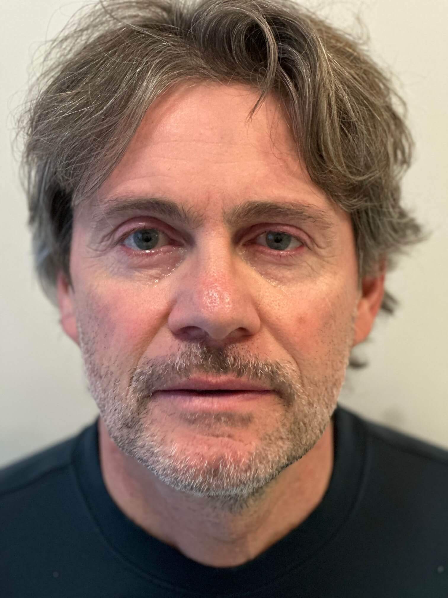 dopo supracor femtolasik correzione astigmatismo ipermetropico composto presbiopia di grado medio elevato dr. angelo appiotti