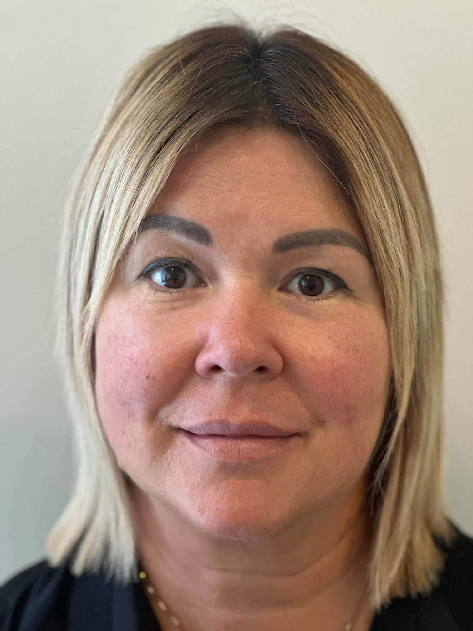 dopo supracor femtolasik correzione ipermetropia presbiopia dr. angelo appiotti