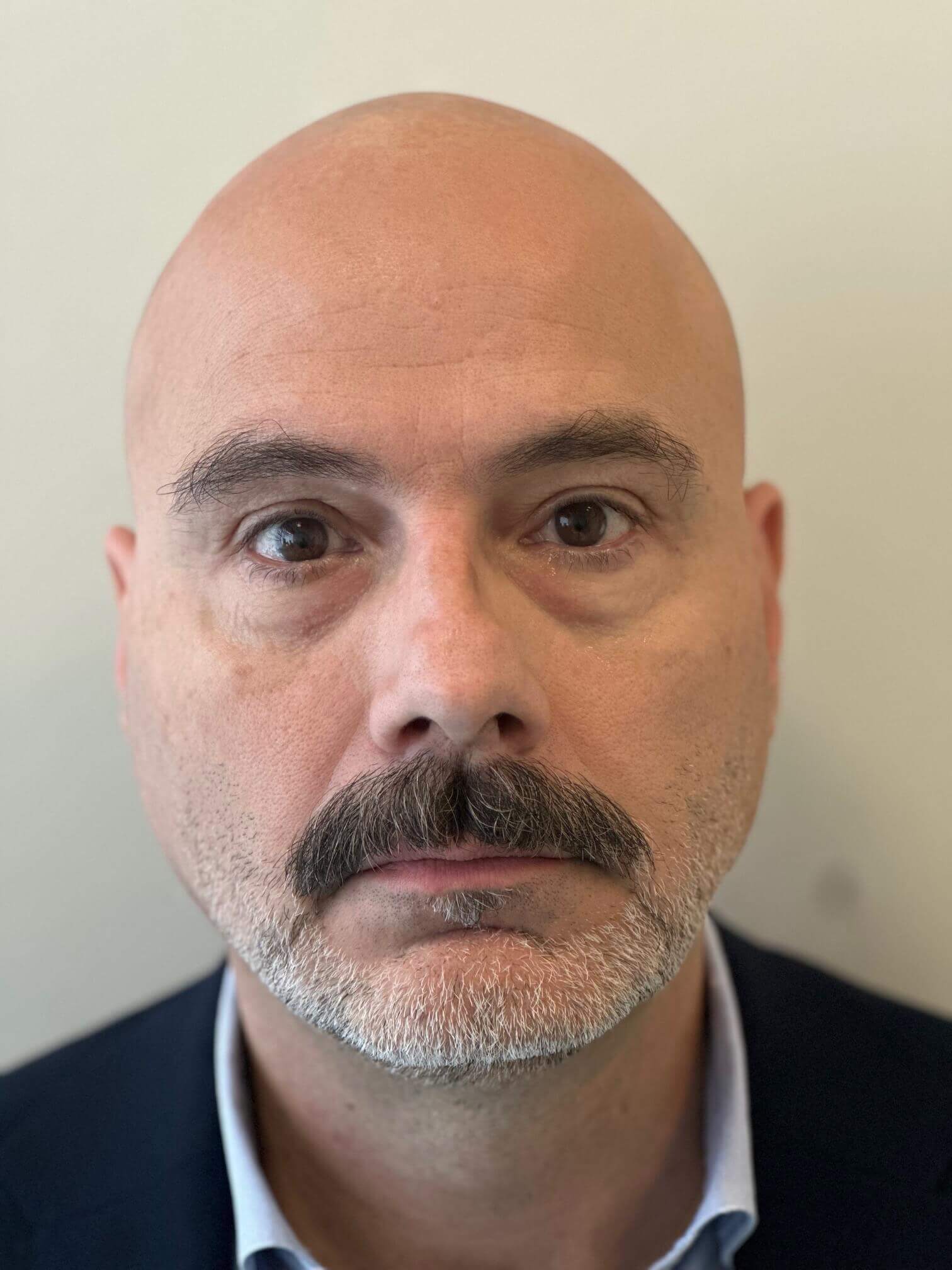 dopo supracor femtolasik correzione ipermetropia presbiopia elevati dr. angelo appiotti