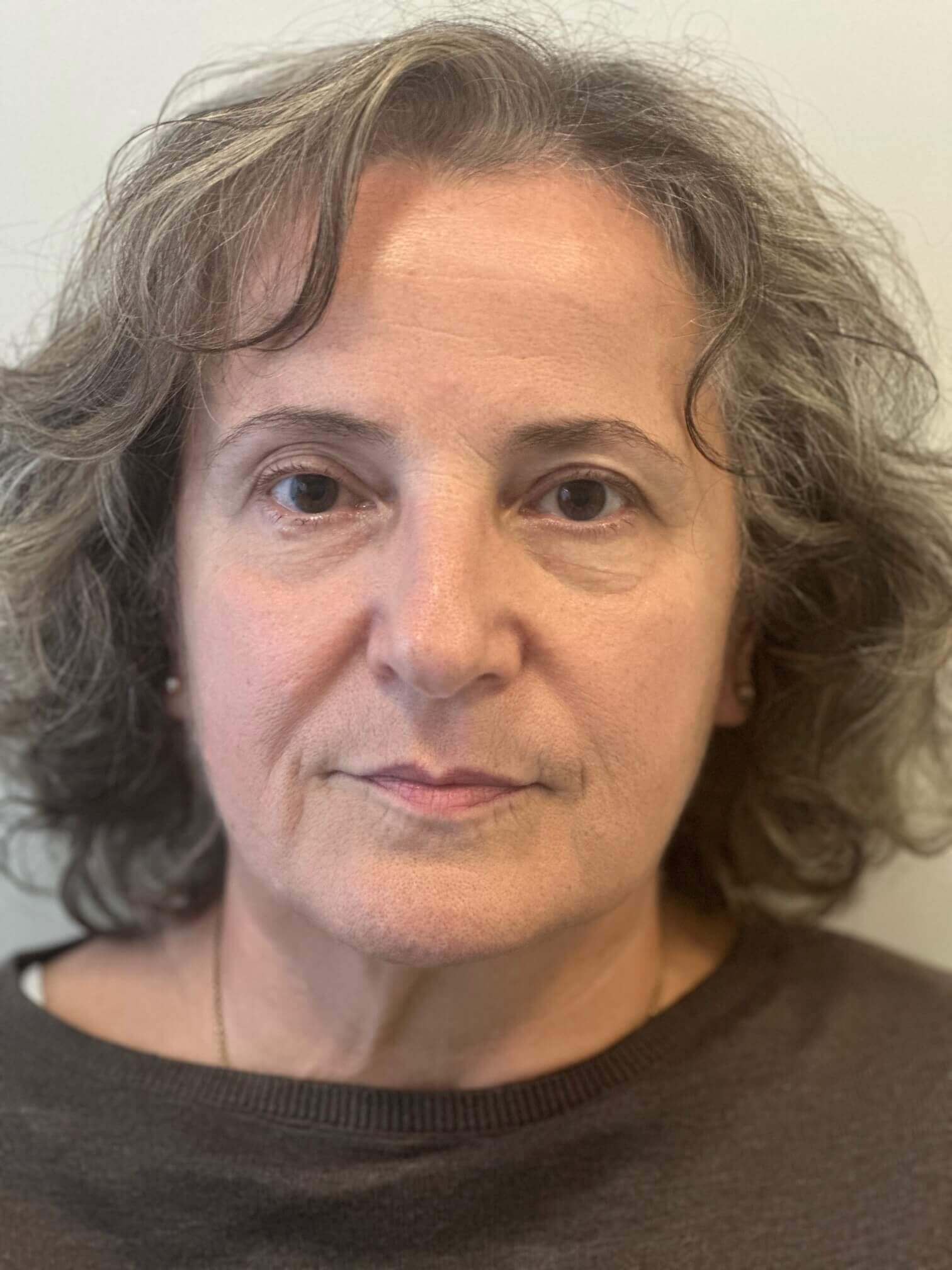 dopo supracor femtolasik correzione ipermetropia presbiopia media elevata dr. angelo appiotti