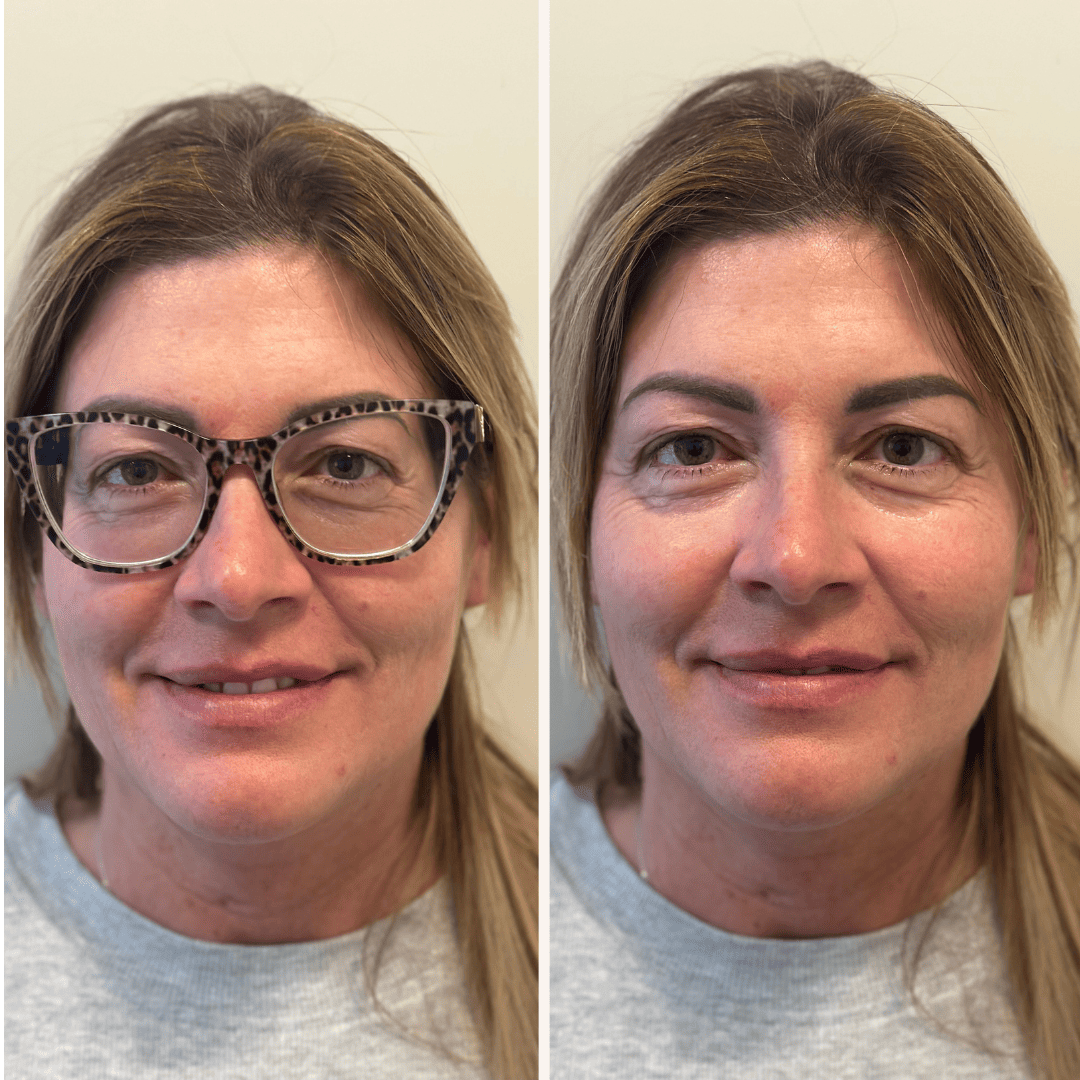 il-problema-della-presbiopia-nei-miopi-elevati-la-storia-di-serena