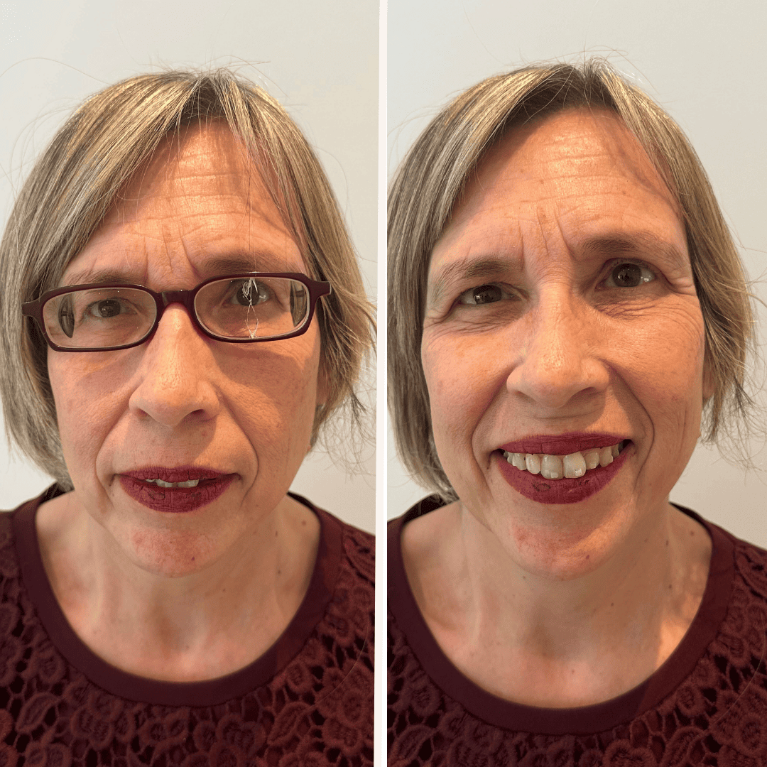 un-caso-difficile-di-miopia-elevata-e-cataratta-la-storia-di-manola