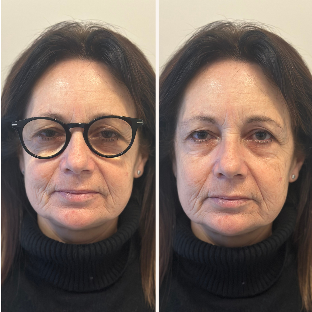 la-chirurgia-refrattiva-non-e-solo-per-i-vip-la-storia-di-sabrina