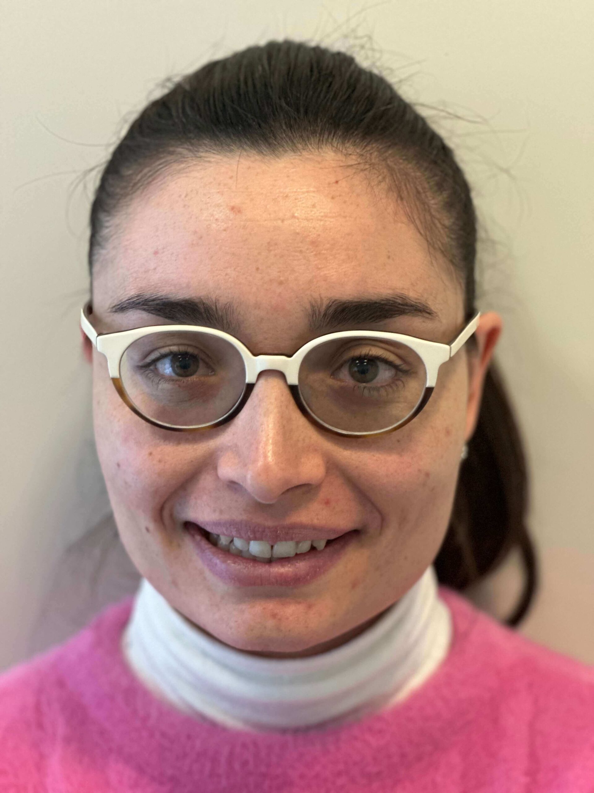 prima icl correzione miopia elevata astigmatismo medio dr. angelo appiotti scaled