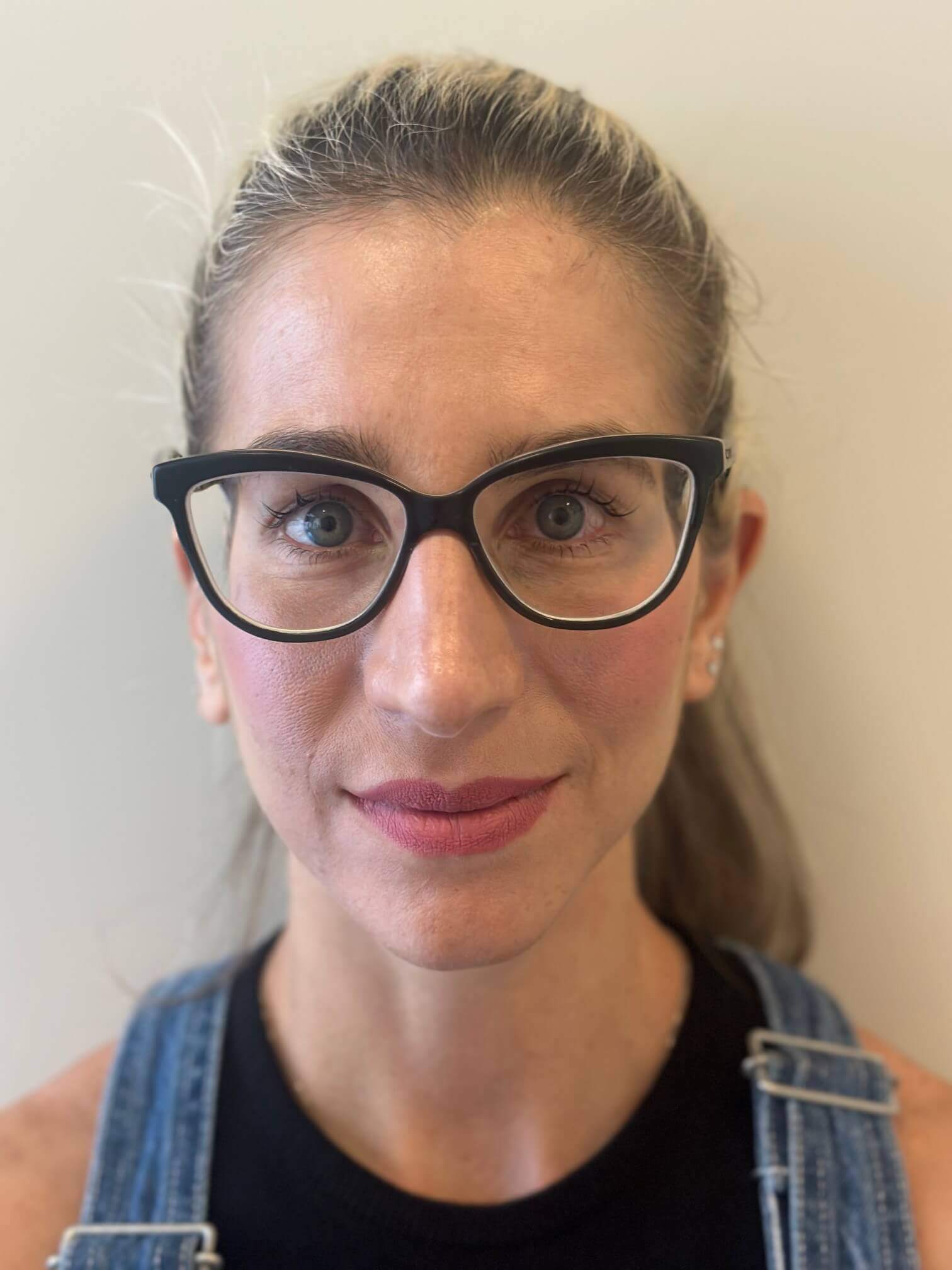 prima icl correzione miopia media astigmatismo lieve dr. angelo appiotti