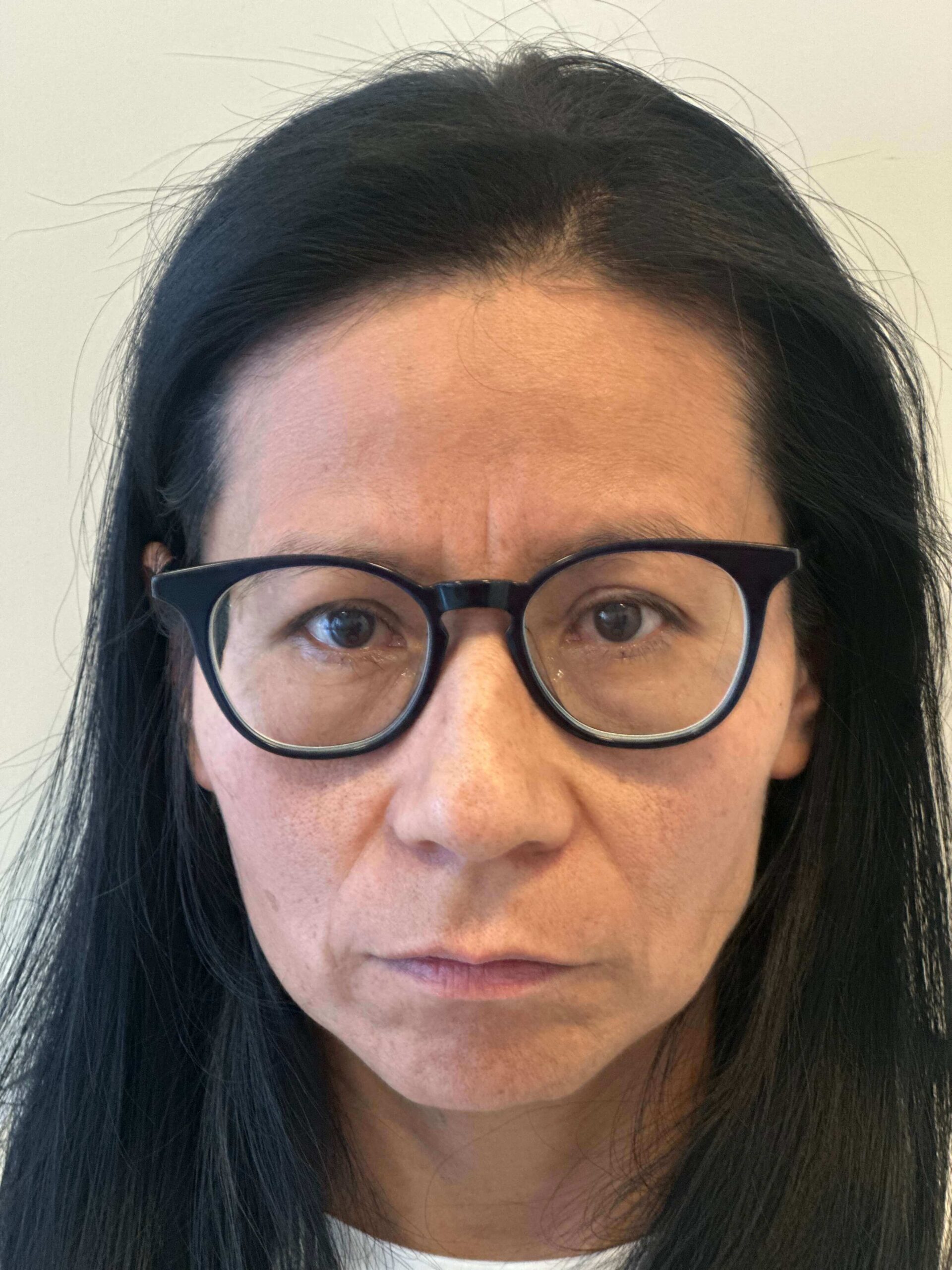 prima prk correzione miopia astigmatismo medi dr. angelo appiotti scaled