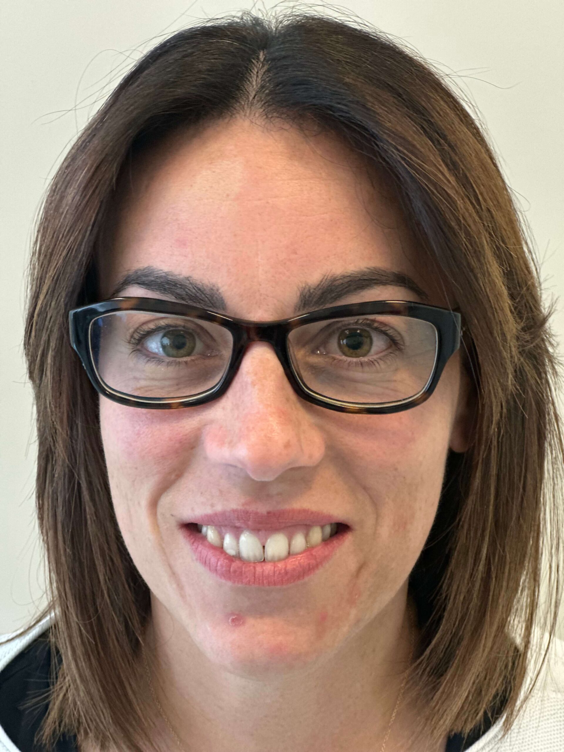 prima prk xtra correzione miopia media elevata astigmatismo medio dr. angelo appiotti scaled