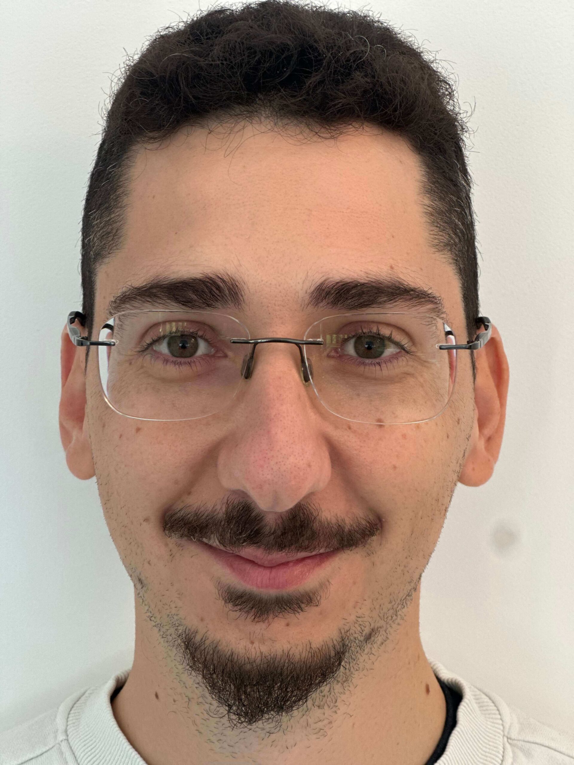 prima relex smile correzione miopia elevata dr. angelo appiotti 1 scaled