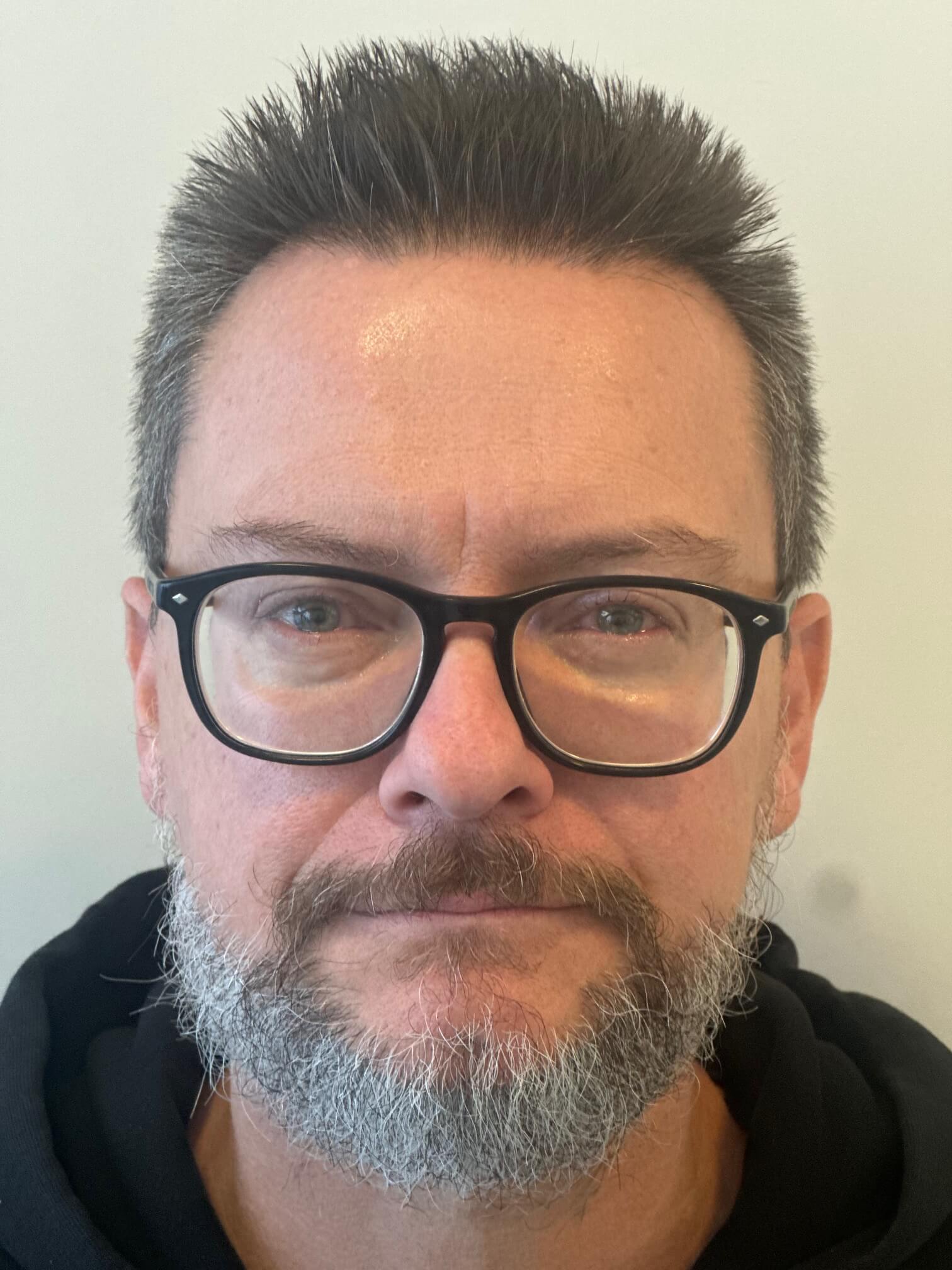 prima relex smile correzione miopia elevata dr. angelo appiotti 2