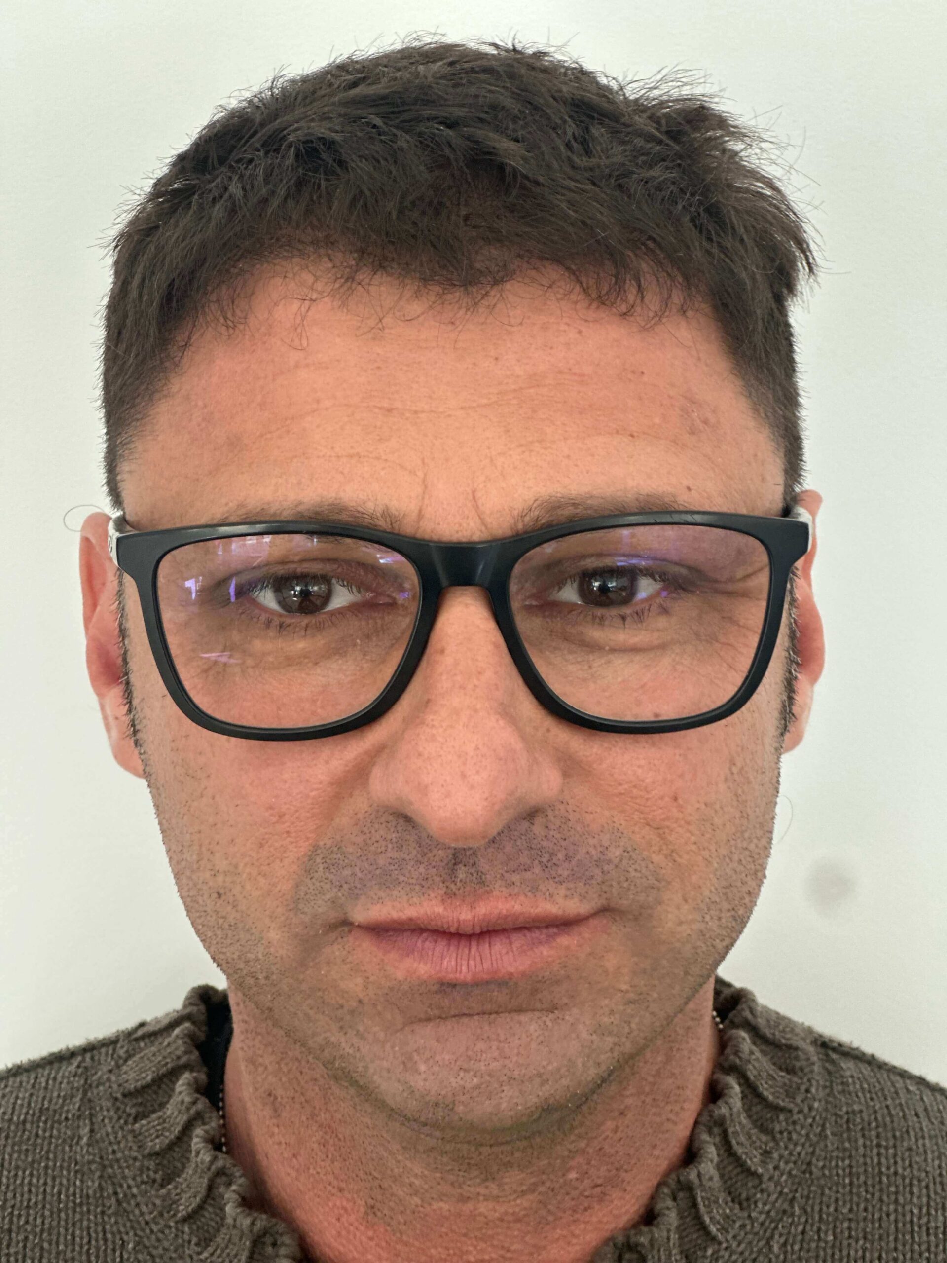 prima supracor femtolasik correzione astigmatismo ipermetropico composto elevato dr. angelo appiotti scaled