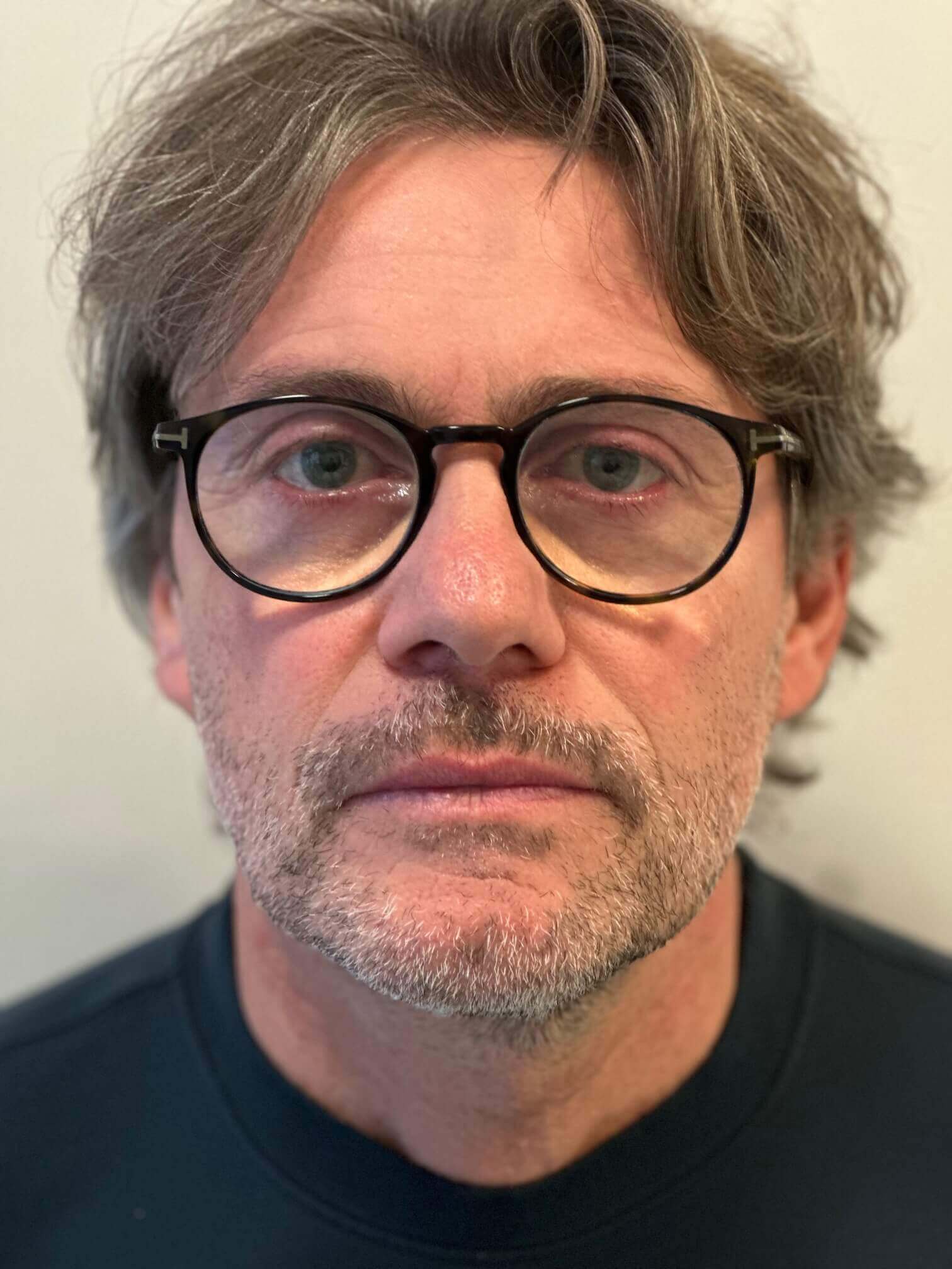 prima supracor femtolasik correzione astigmatismo ipermetropico composto presbiopia di grado medio elevato dr. angelo appiotti