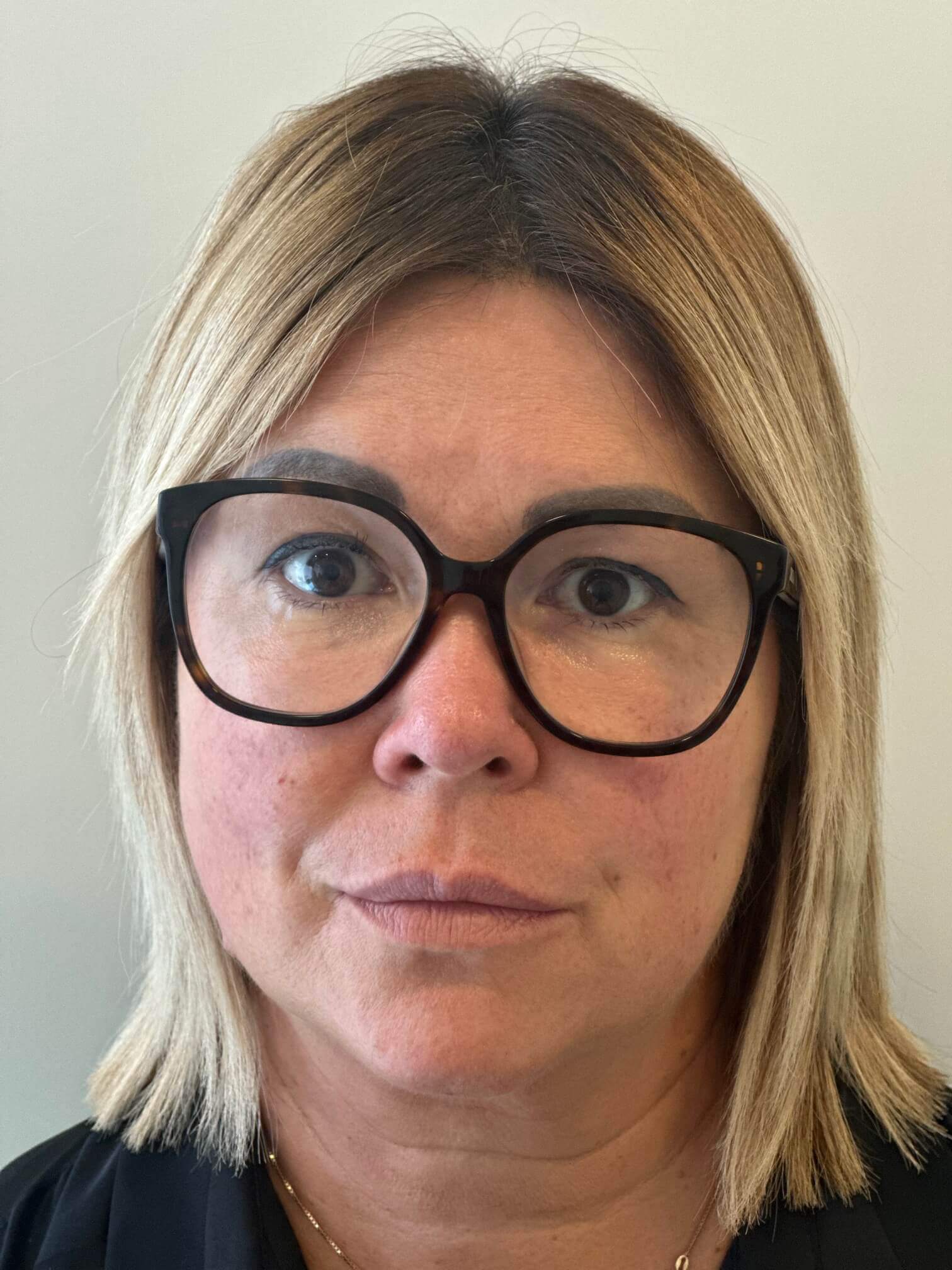 prima supracor femtolasik correzione ipermetropia presbiopia dr. angelo appiotti