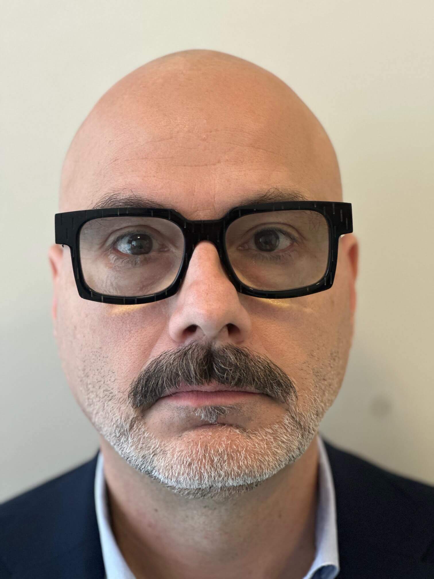 prima supracor femtolasik correzione ipermetropia presbiopia elevati dr. angelo appiotti